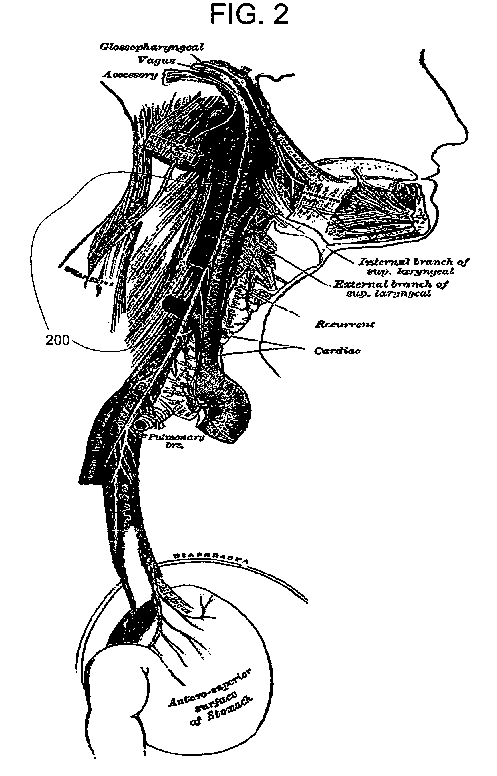 Methods and apparatus for treating anaphylaxis using electrical modulation