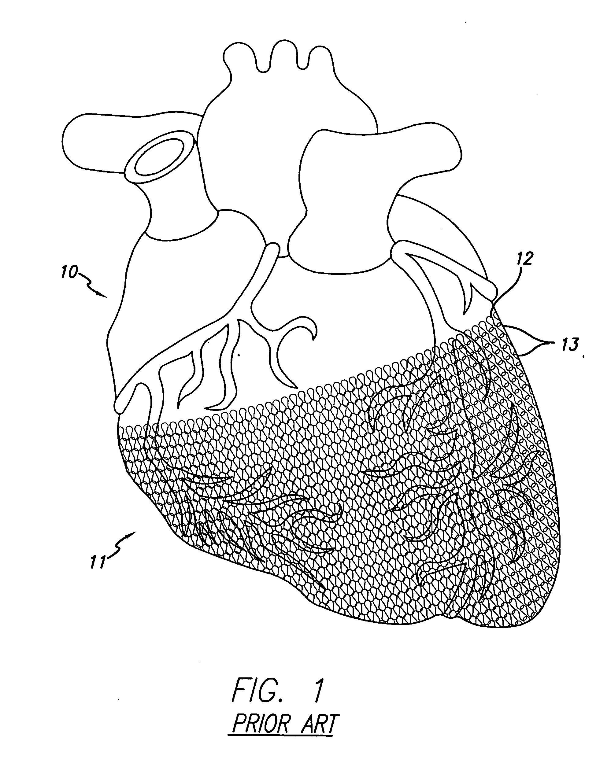 Cardiac harness having radiopaque coating and method of use