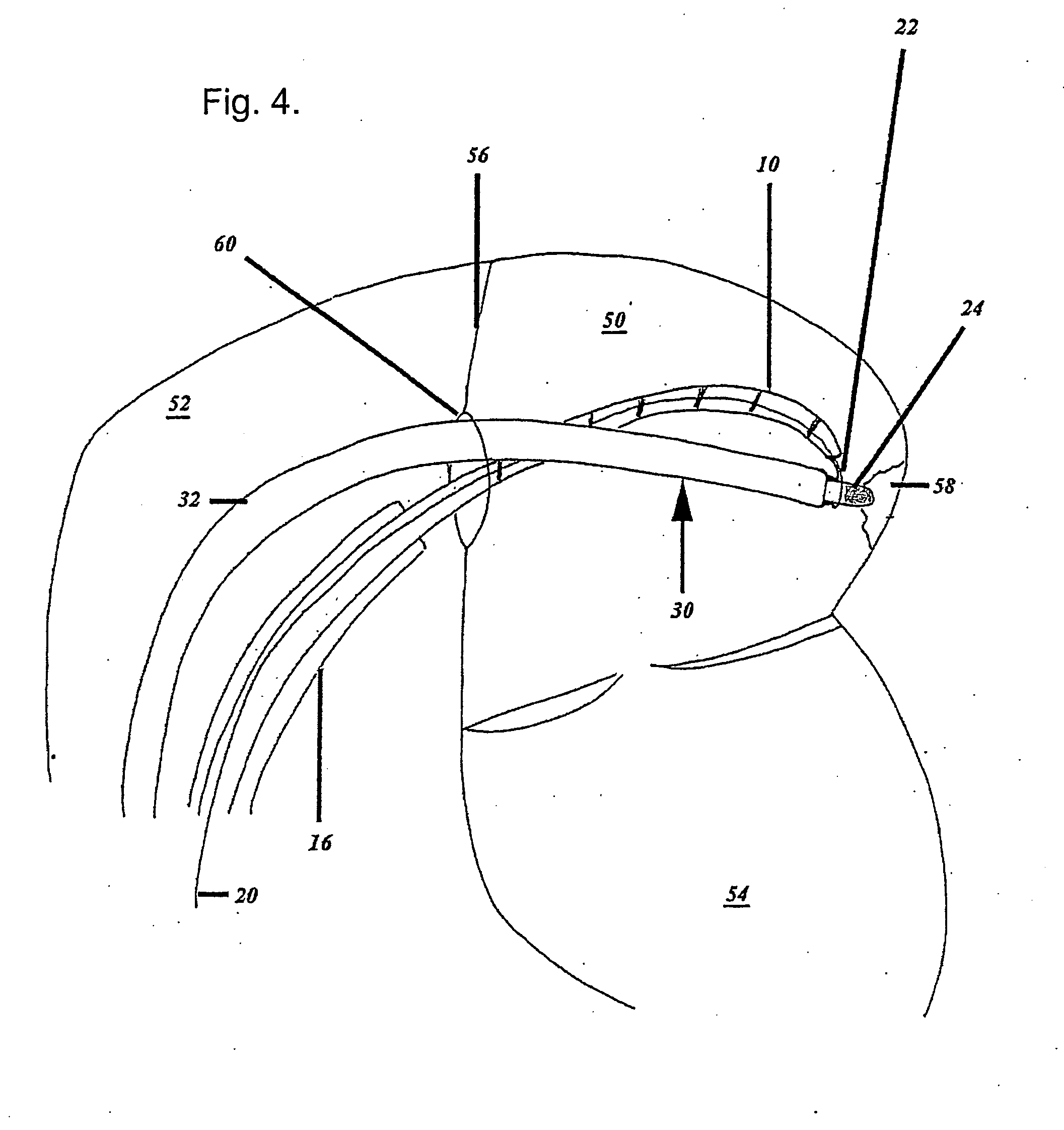 Catheter, Apparatus for Creating a Linear Ablation and a Method of Ablating Tissue