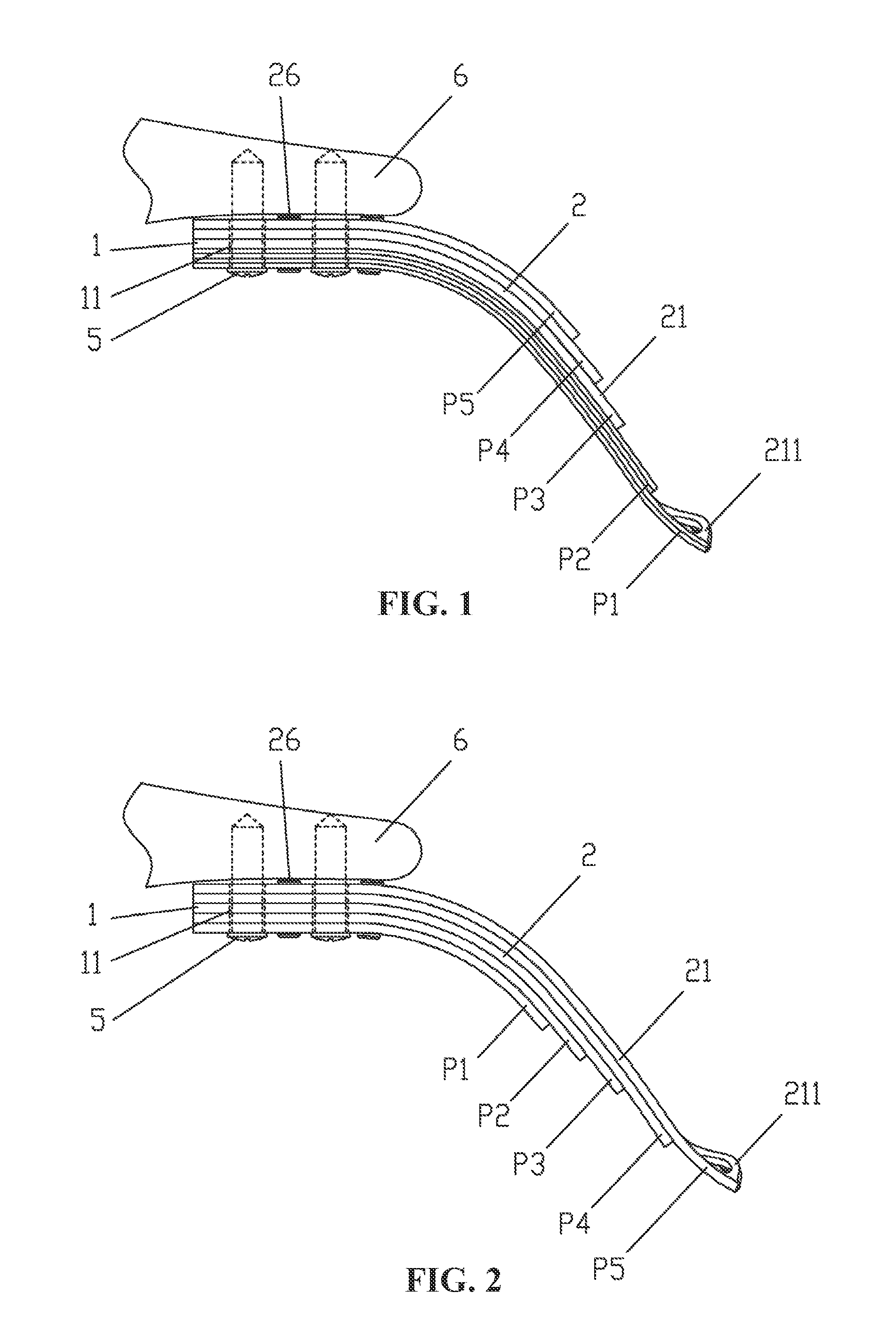 Layered soft palate support and implantation method