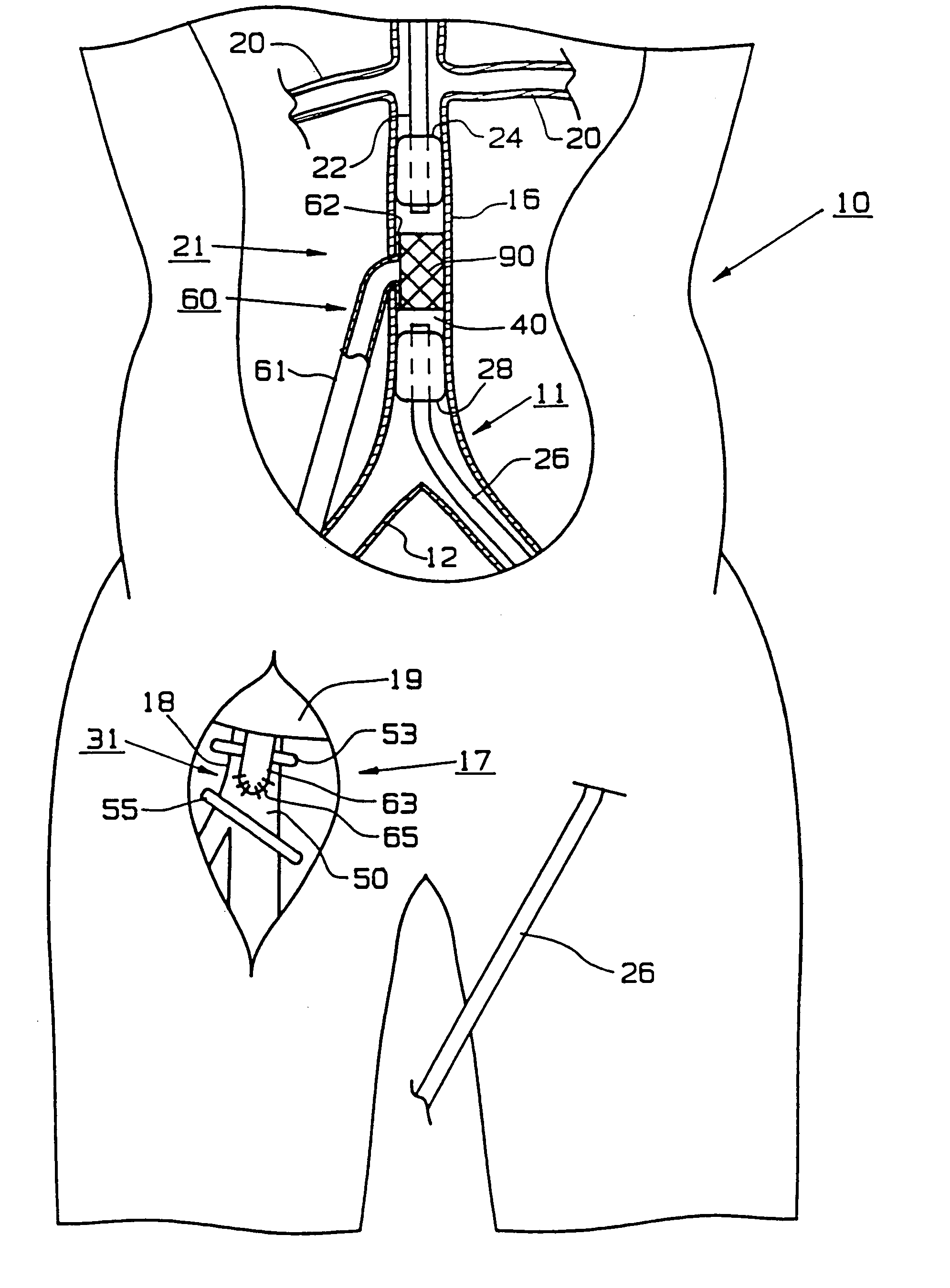 Bypass grafting method