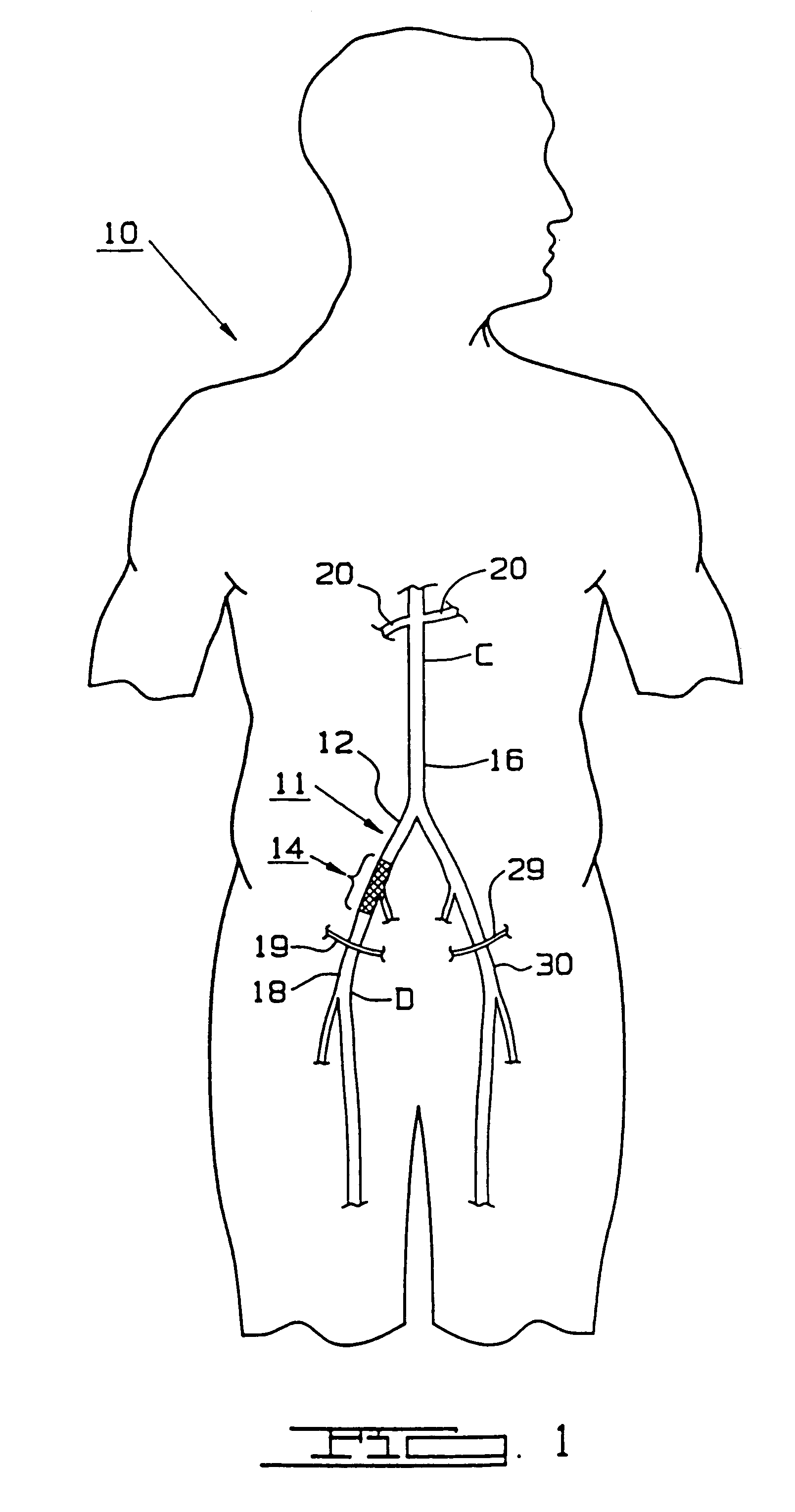 Bypass grafting method