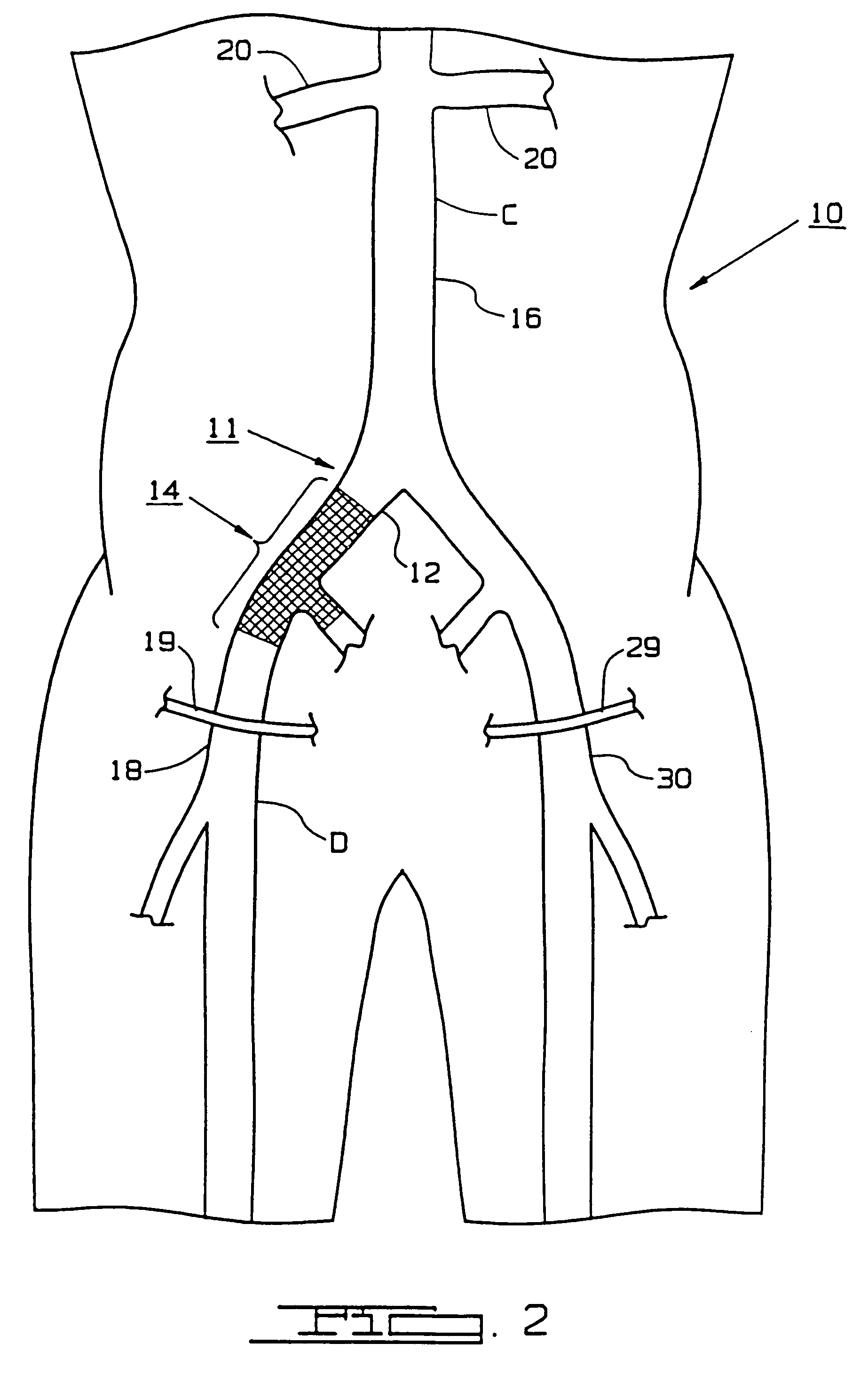 Bypass grafting method