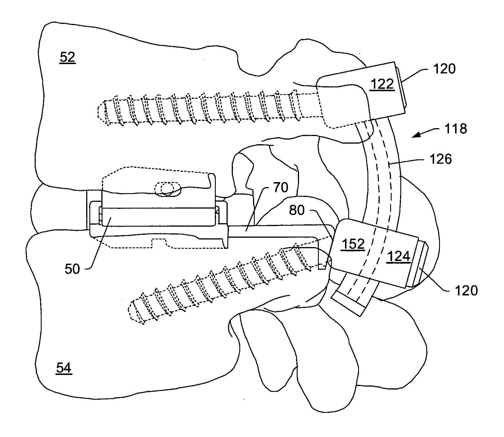 Dynamic interbody device