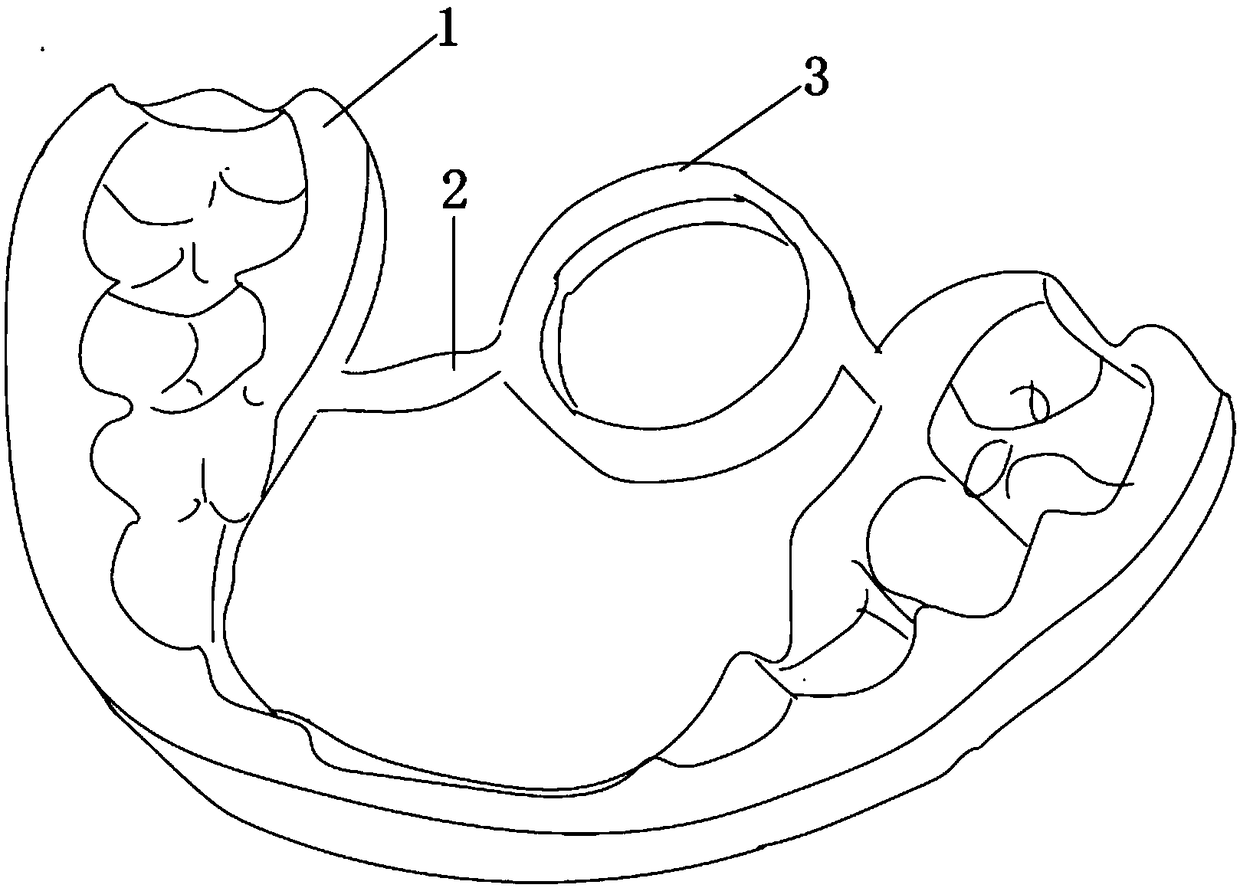 Admission passage pull-out guide plate on palate side of embedded tooth of upper jaw and manufacturing method thereof