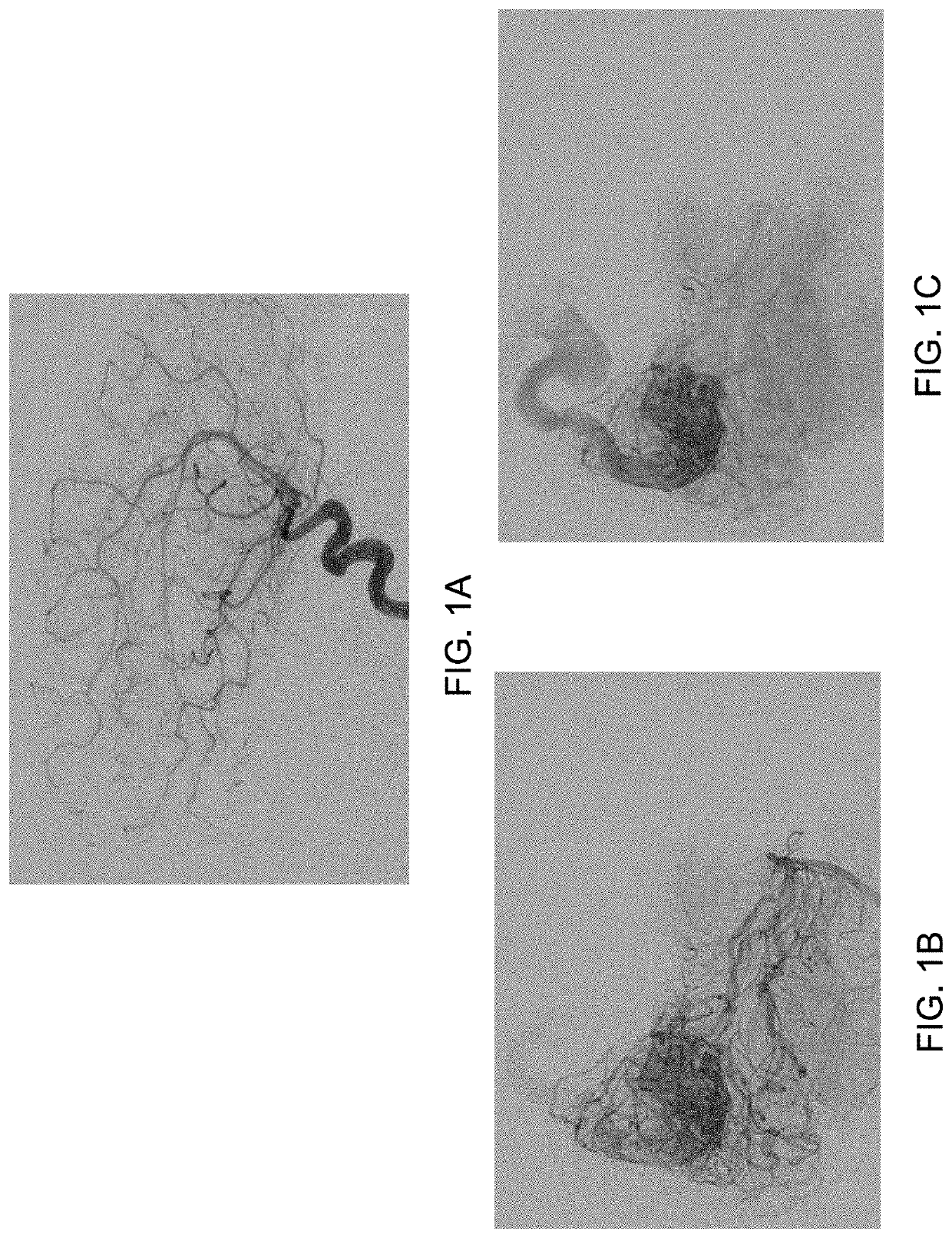 Endovascular catheter with controllable tip