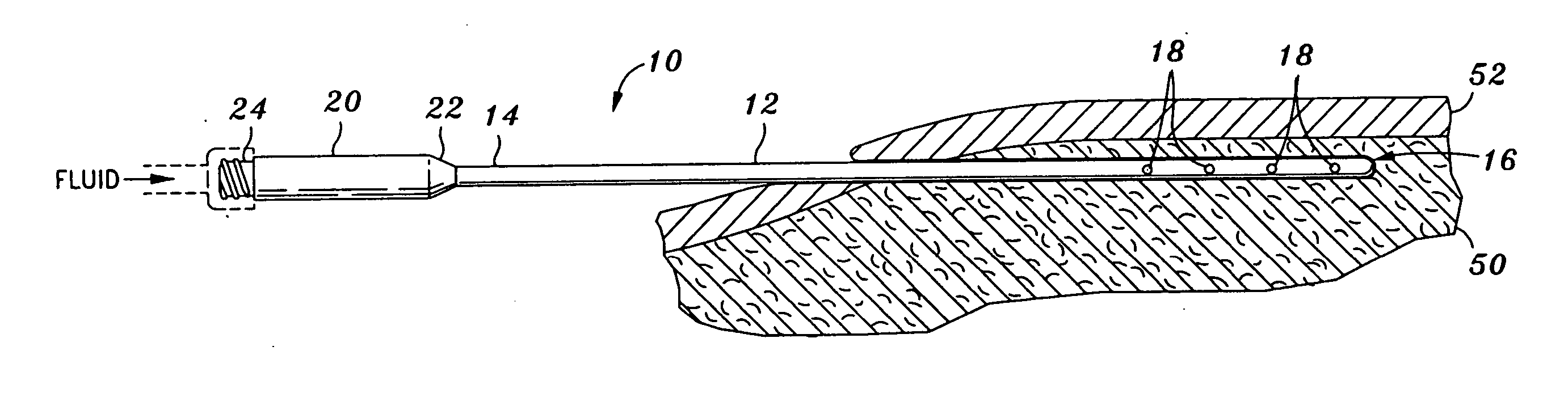 Infiltration cannula