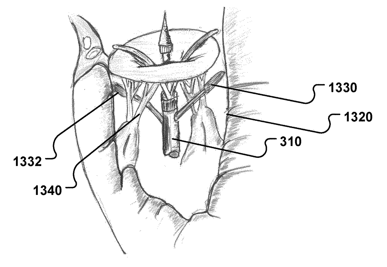 Medical system, a device for collecting chordae and/or leaflets and a method therefor