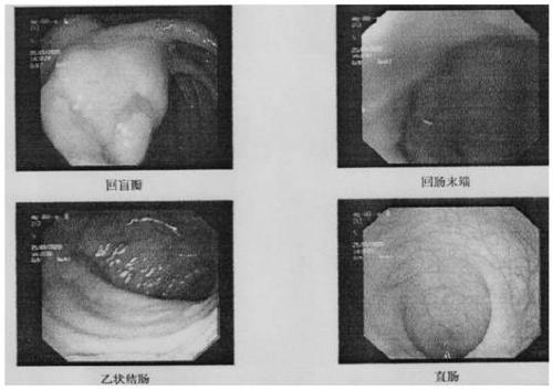 Traditional Chinese medicine composition and traditional Chinese medicine preparation for preventing relapse of postoperative intestinal polyp