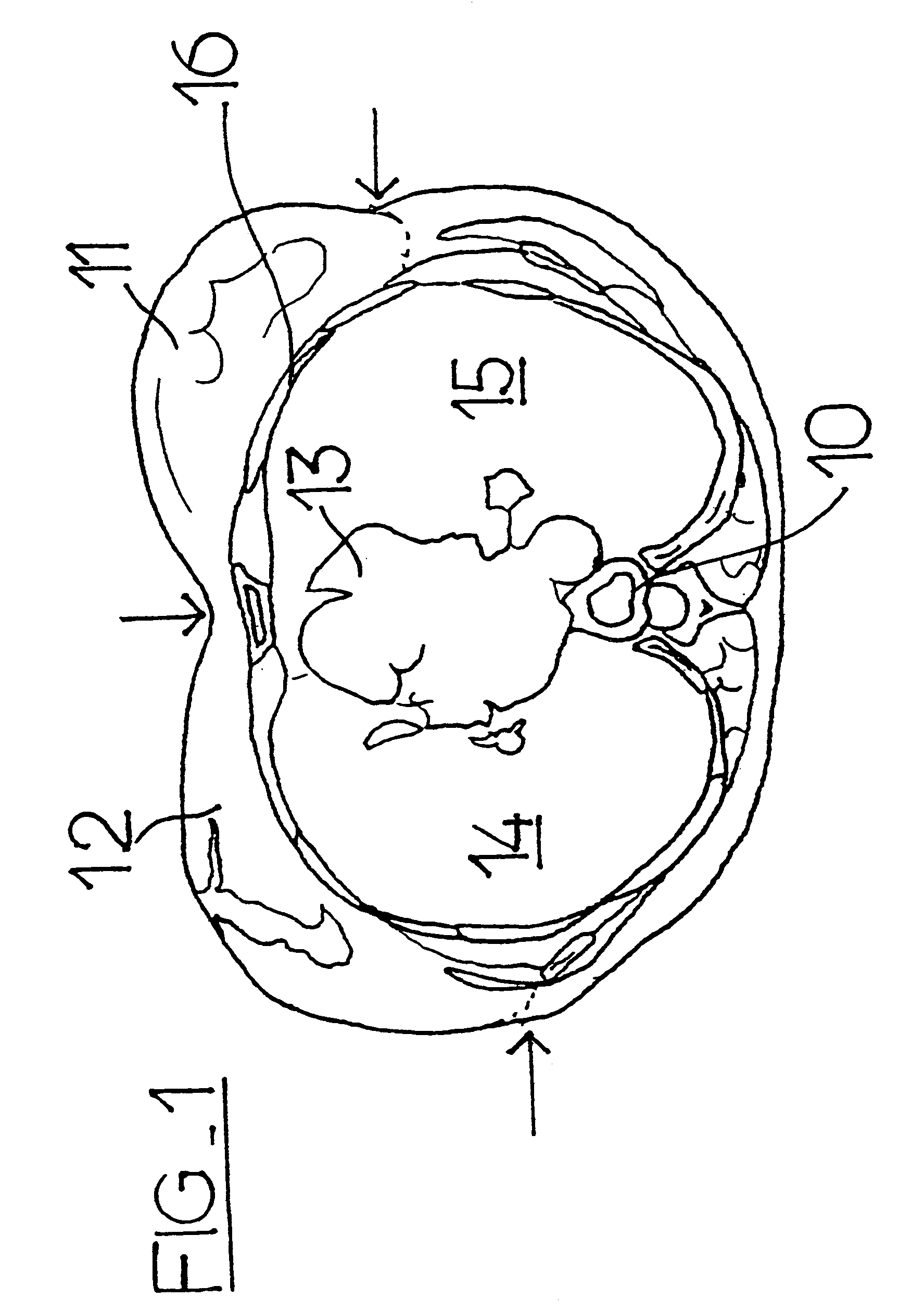 Breast prosthesis