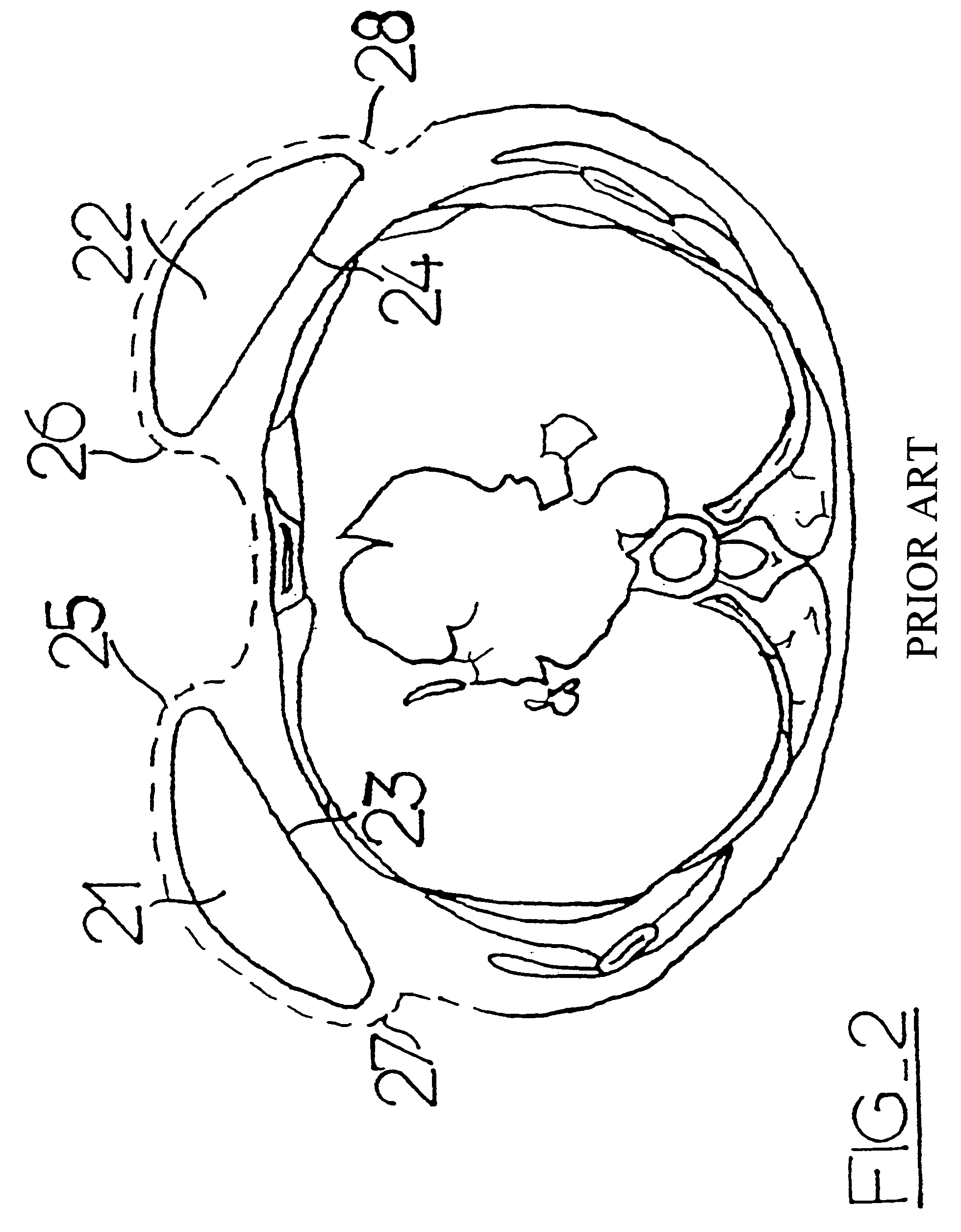 Breast prosthesis