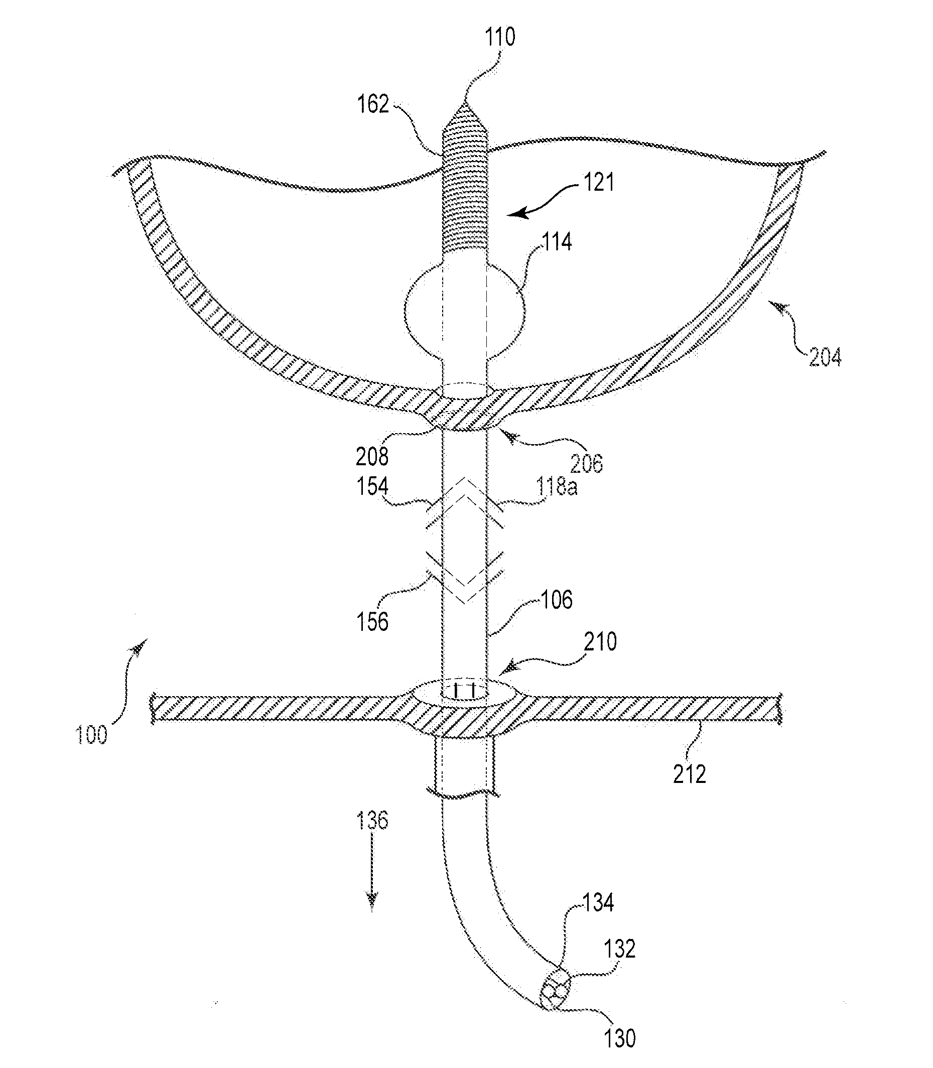 Anastomosis device and related methods