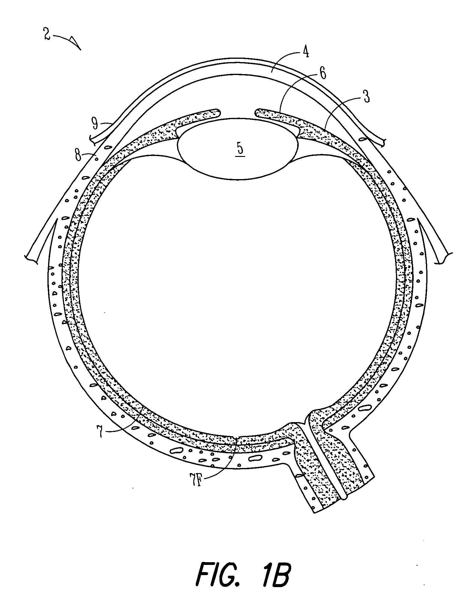 Lacrimal implant detection