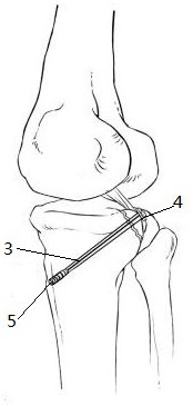 Fixing suspension device for posterior cruciate ligament avulsion fracture reduction surgery and operation method