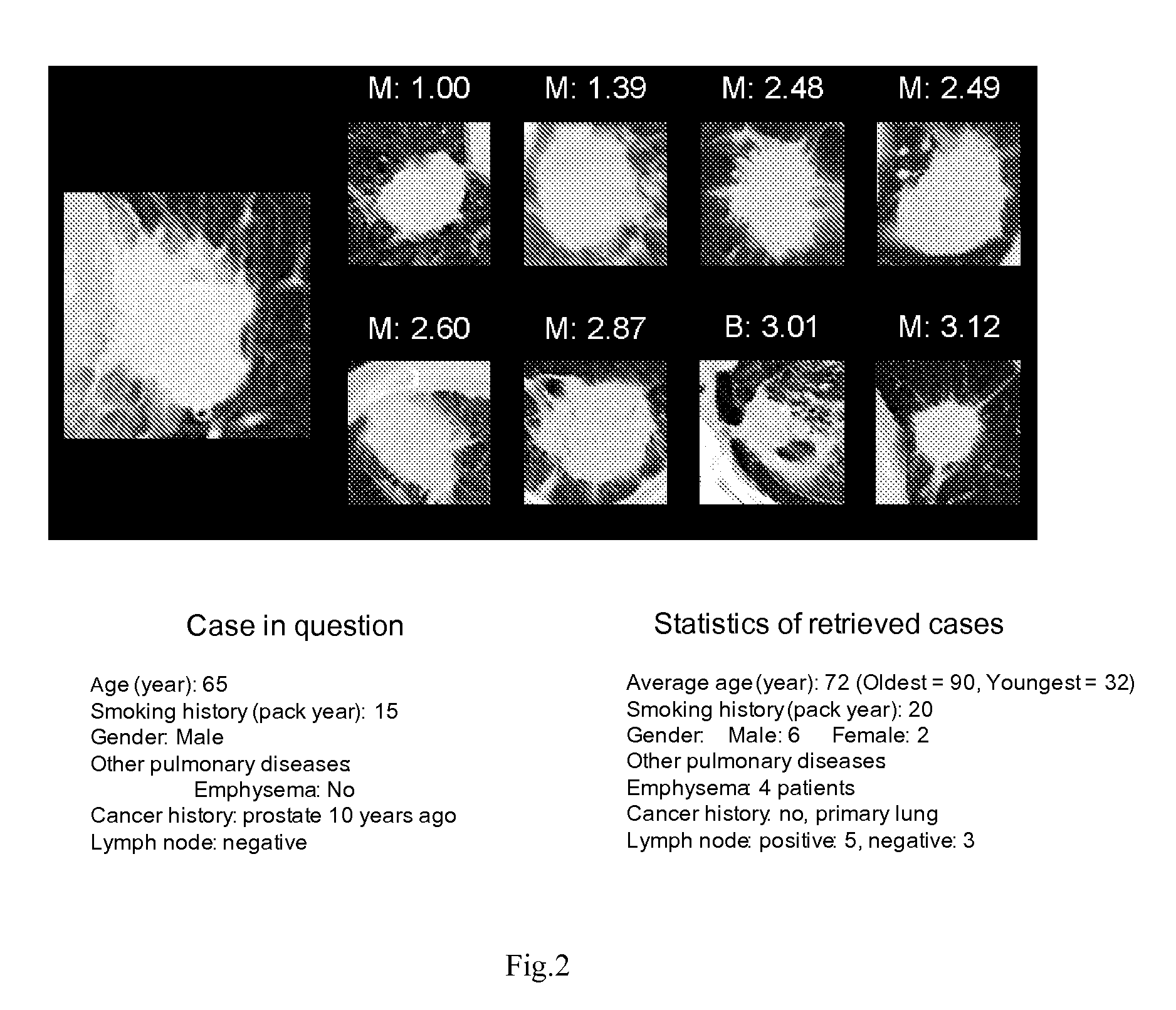 Method and apparatus for refining similar case search