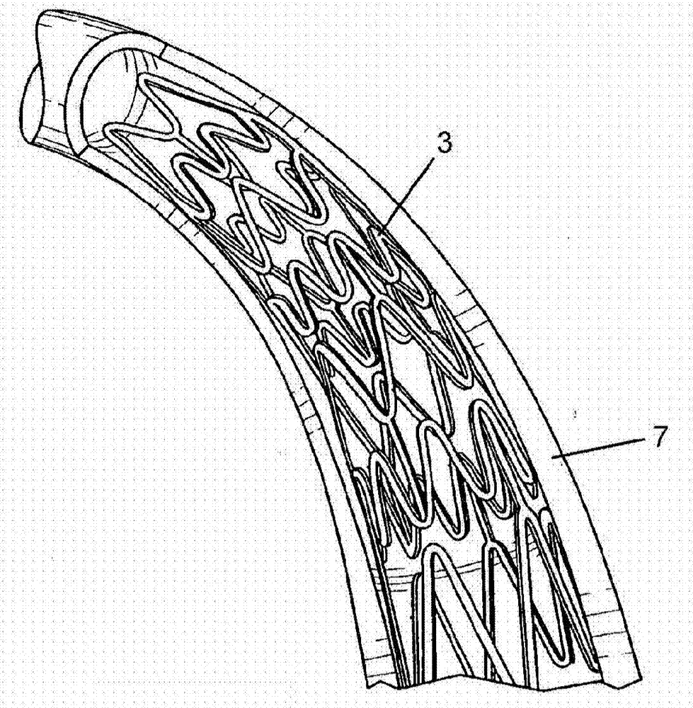 Endoluminal device and method