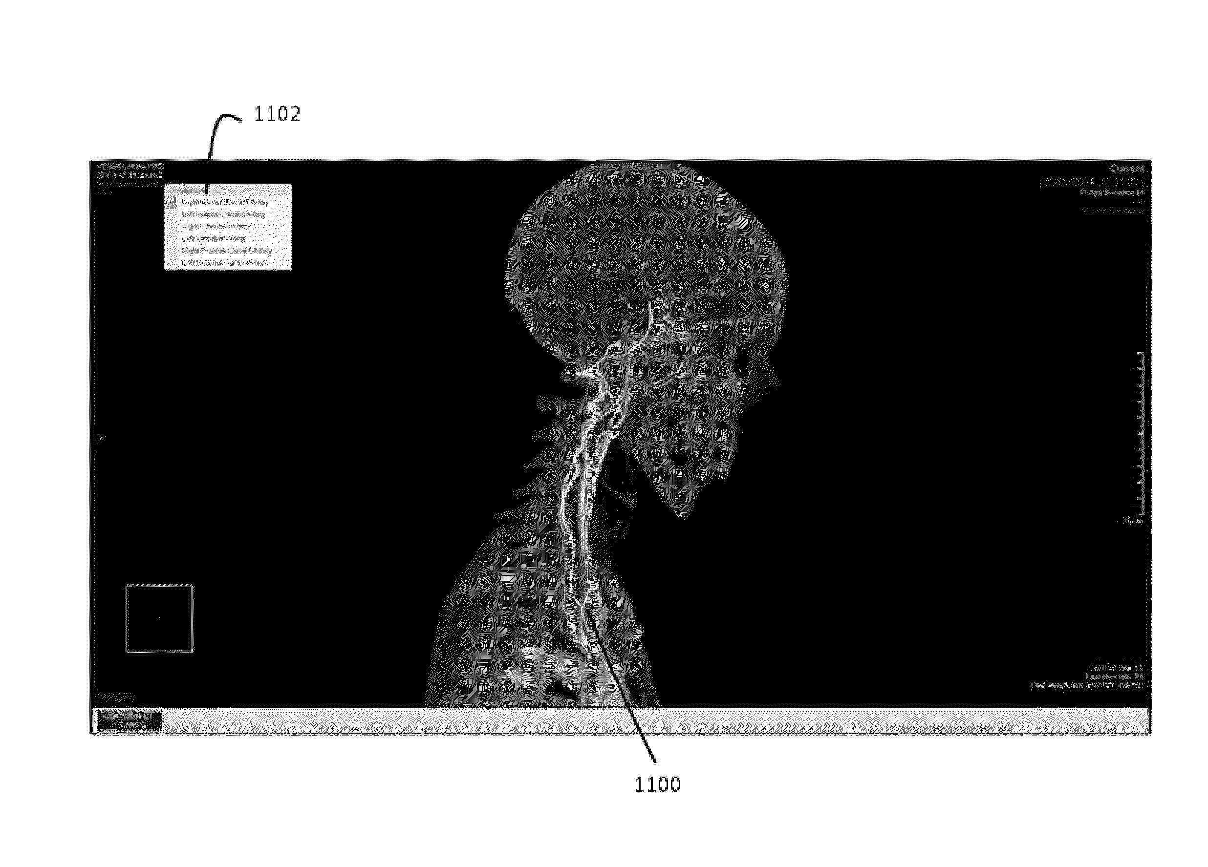 Method for segmentation of the head-neck arteries, brain and skull in medical images