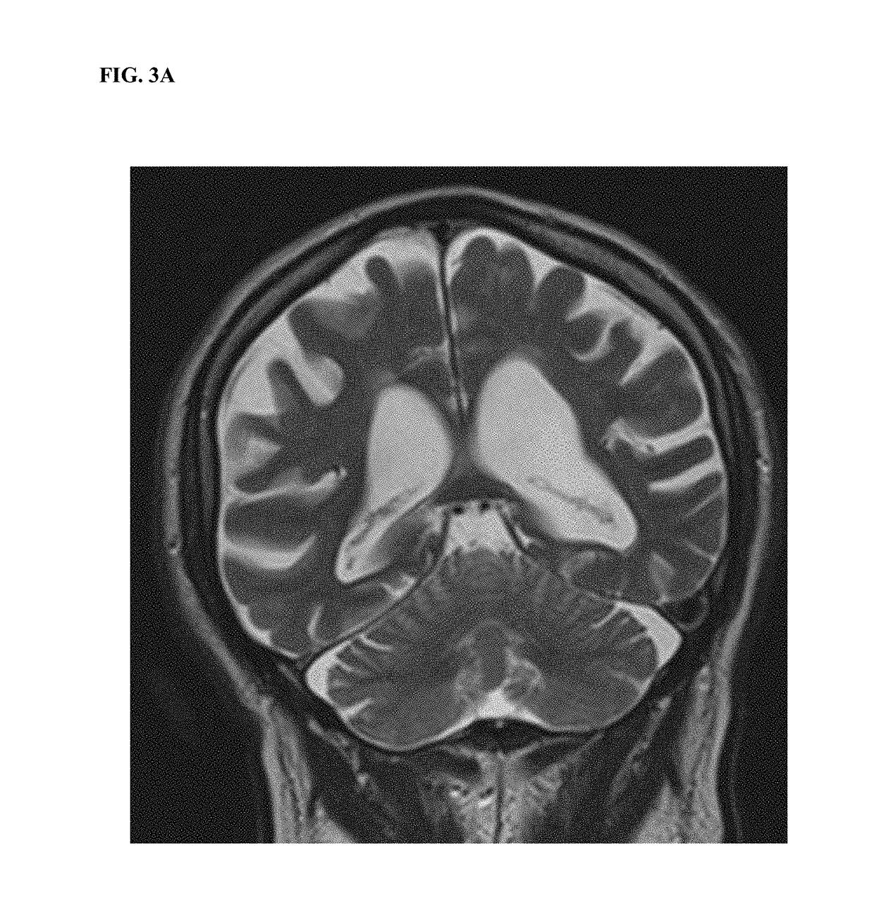 Extracellular DNA as a therapeutic target in neurodegeneration