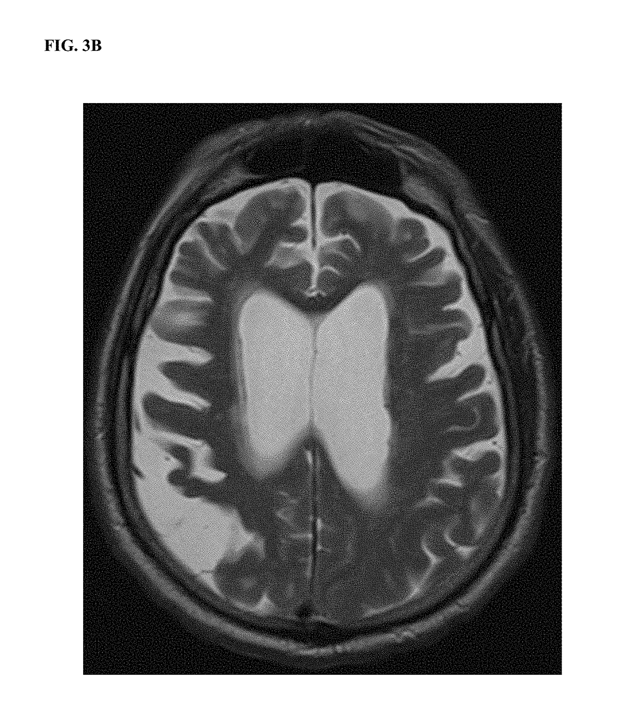 Extracellular DNA as a therapeutic target in neurodegeneration