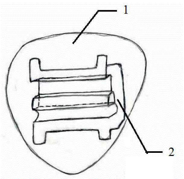 Double wire straight wire arch orthodontic device and tooth orthodontic method