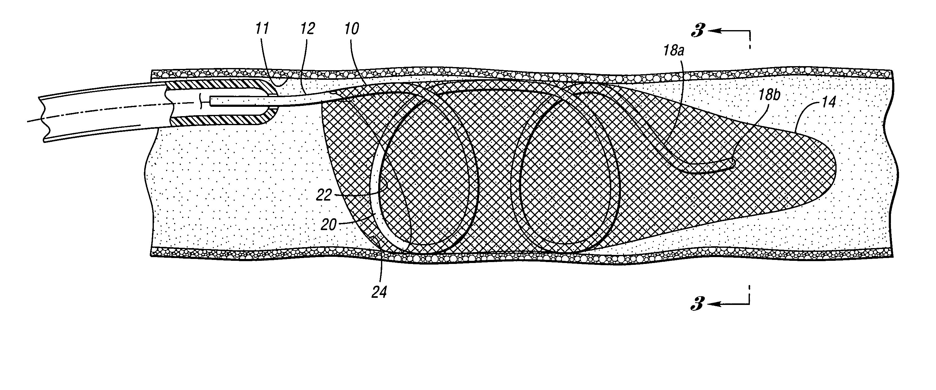 Embolic protection device having inflatable frame