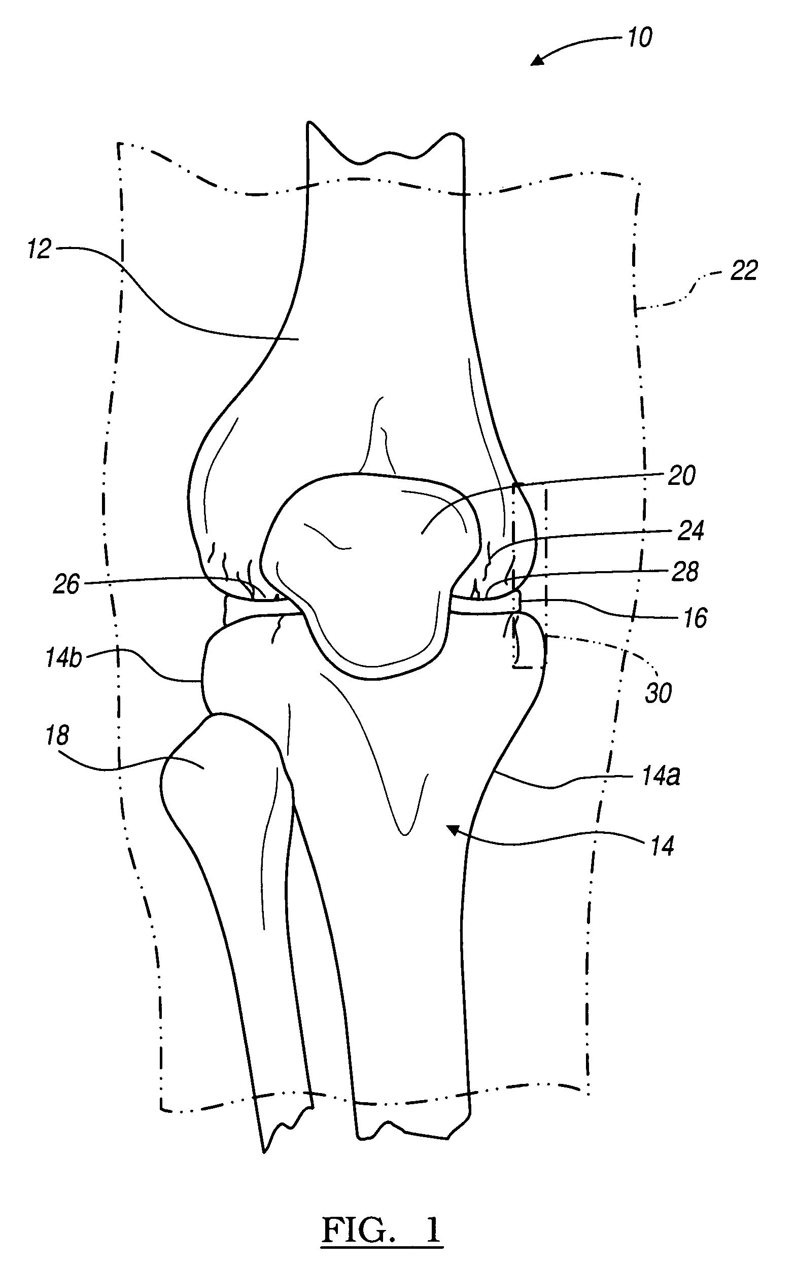 Instrumentation for knee resection