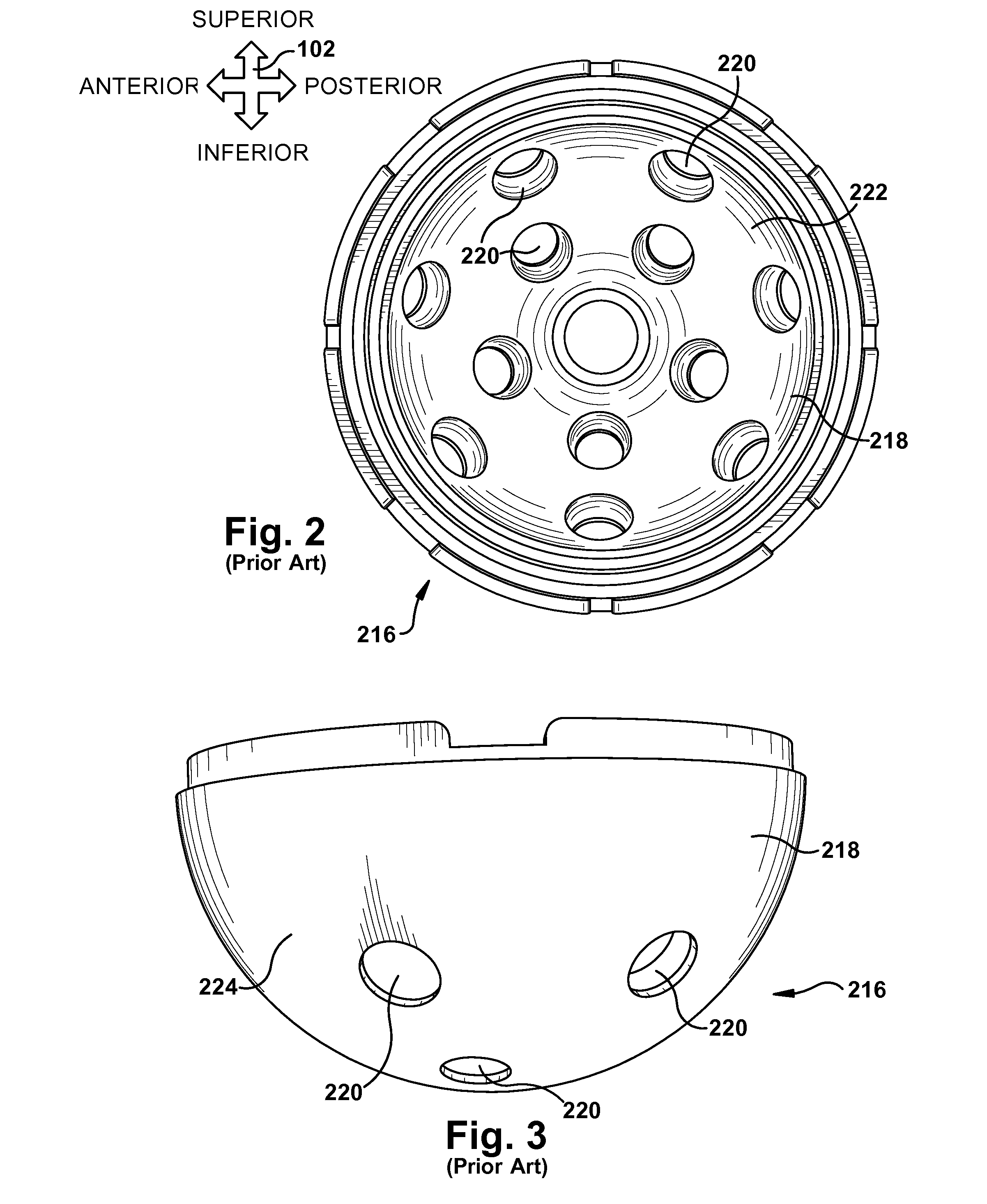 System and method for assisting with attachment of a stock implant to a patient tissue