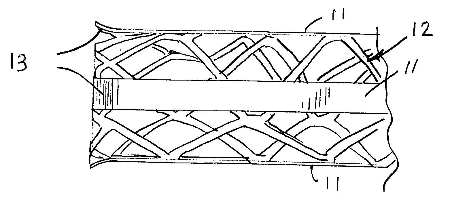 Stent with auxiliary treatment structure