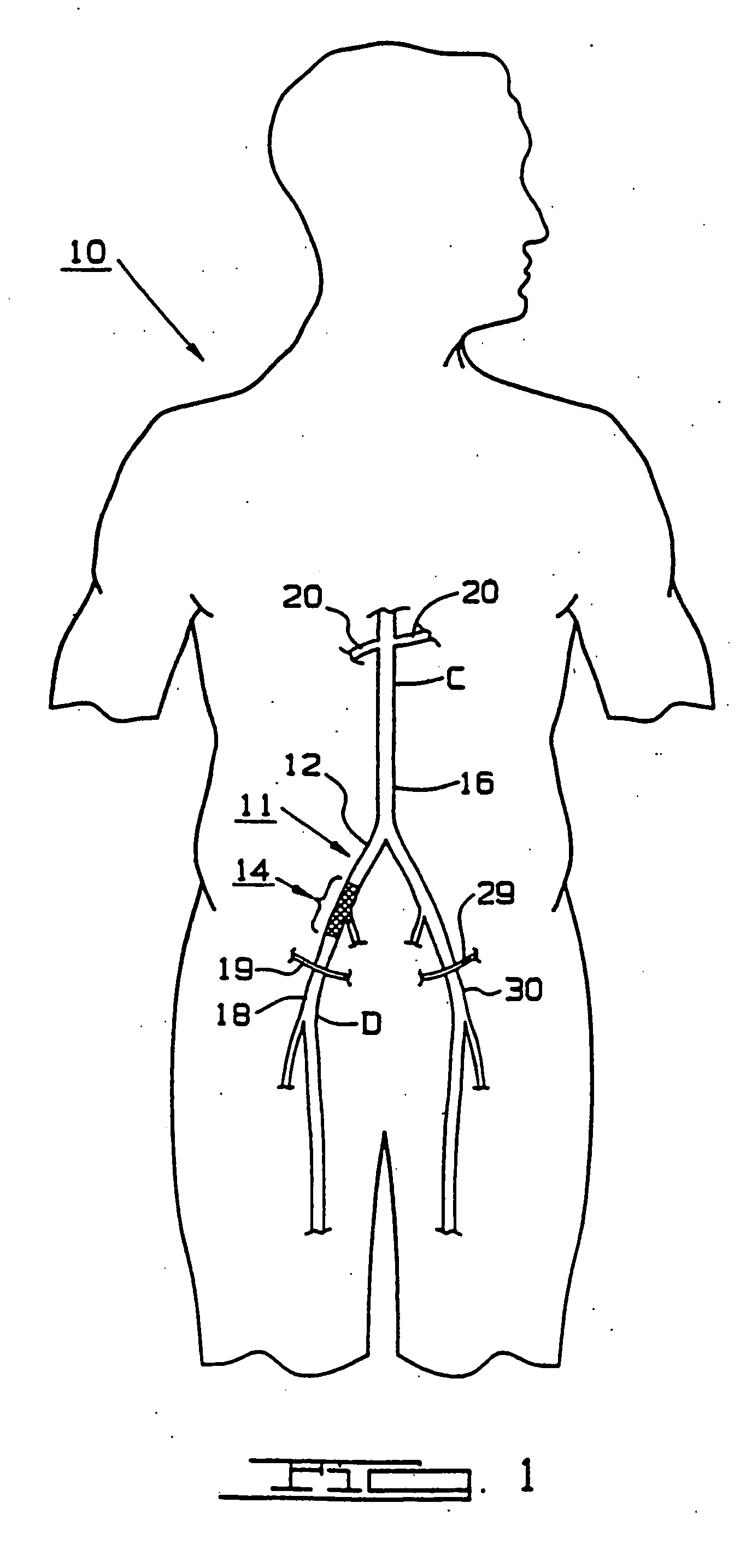 Graft implant method