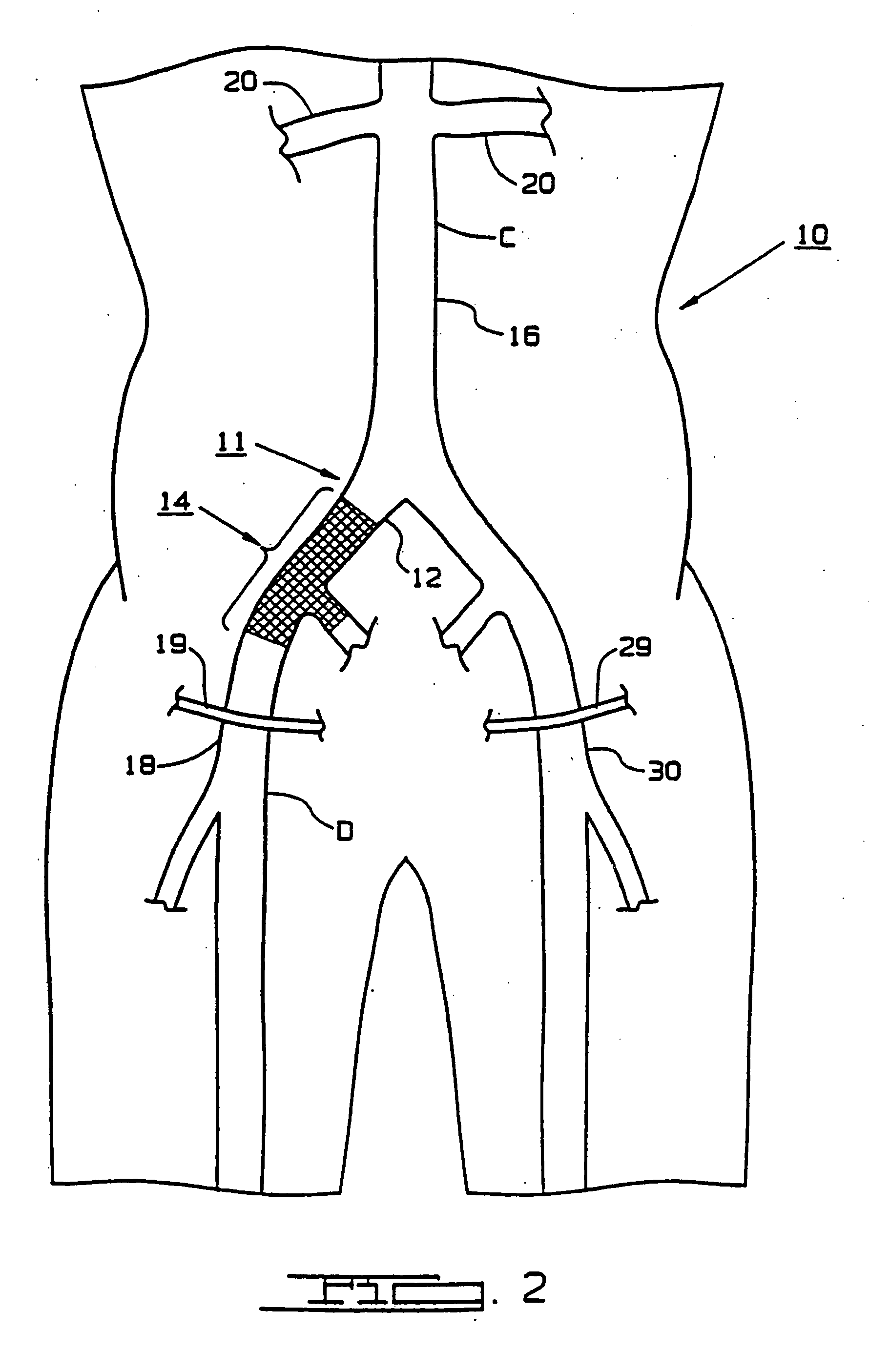 Graft implant method