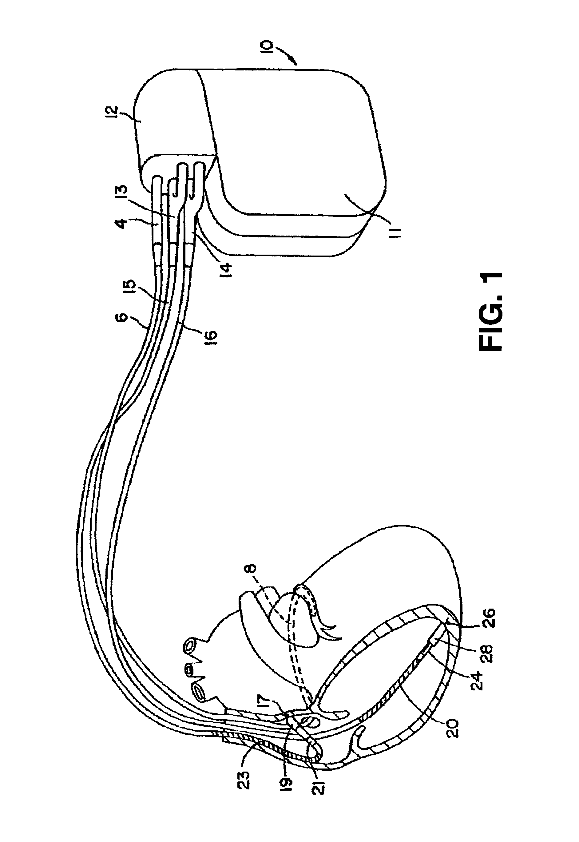 Method and apparatus for monitoring tissue fluid content for use in an implantable cardiac device