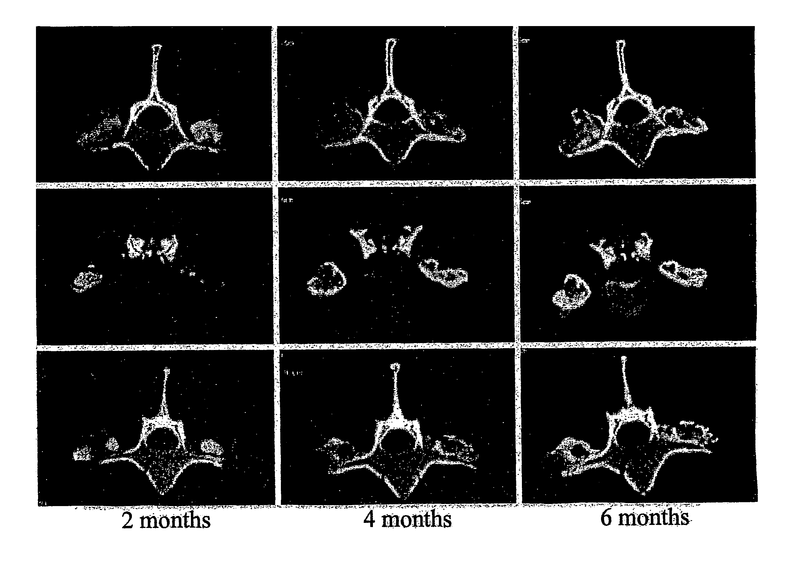 Spinal fusion methods and devices