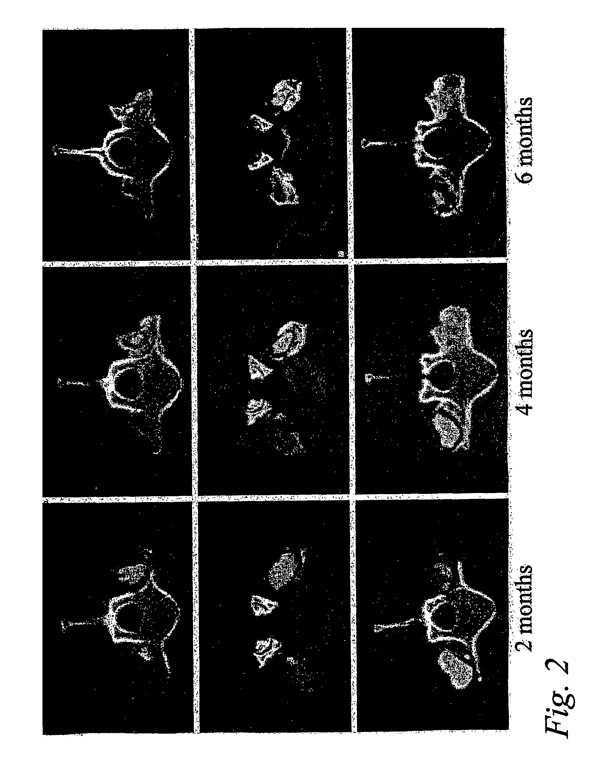 Spinal fusion methods and devices