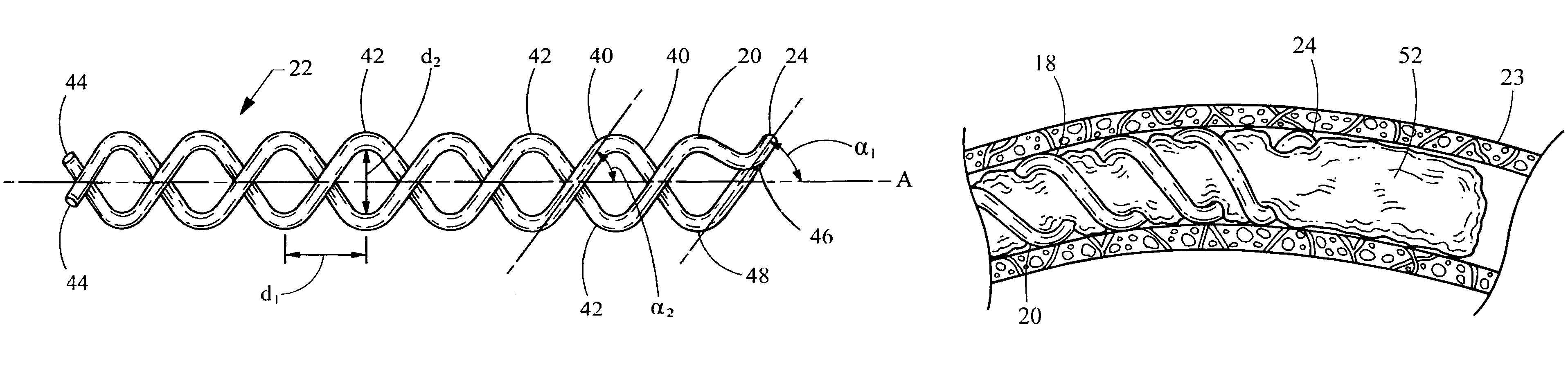 Thrombus removal device