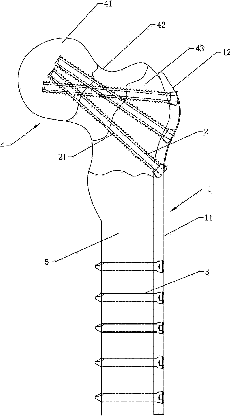 Proximal lateral femur locking device