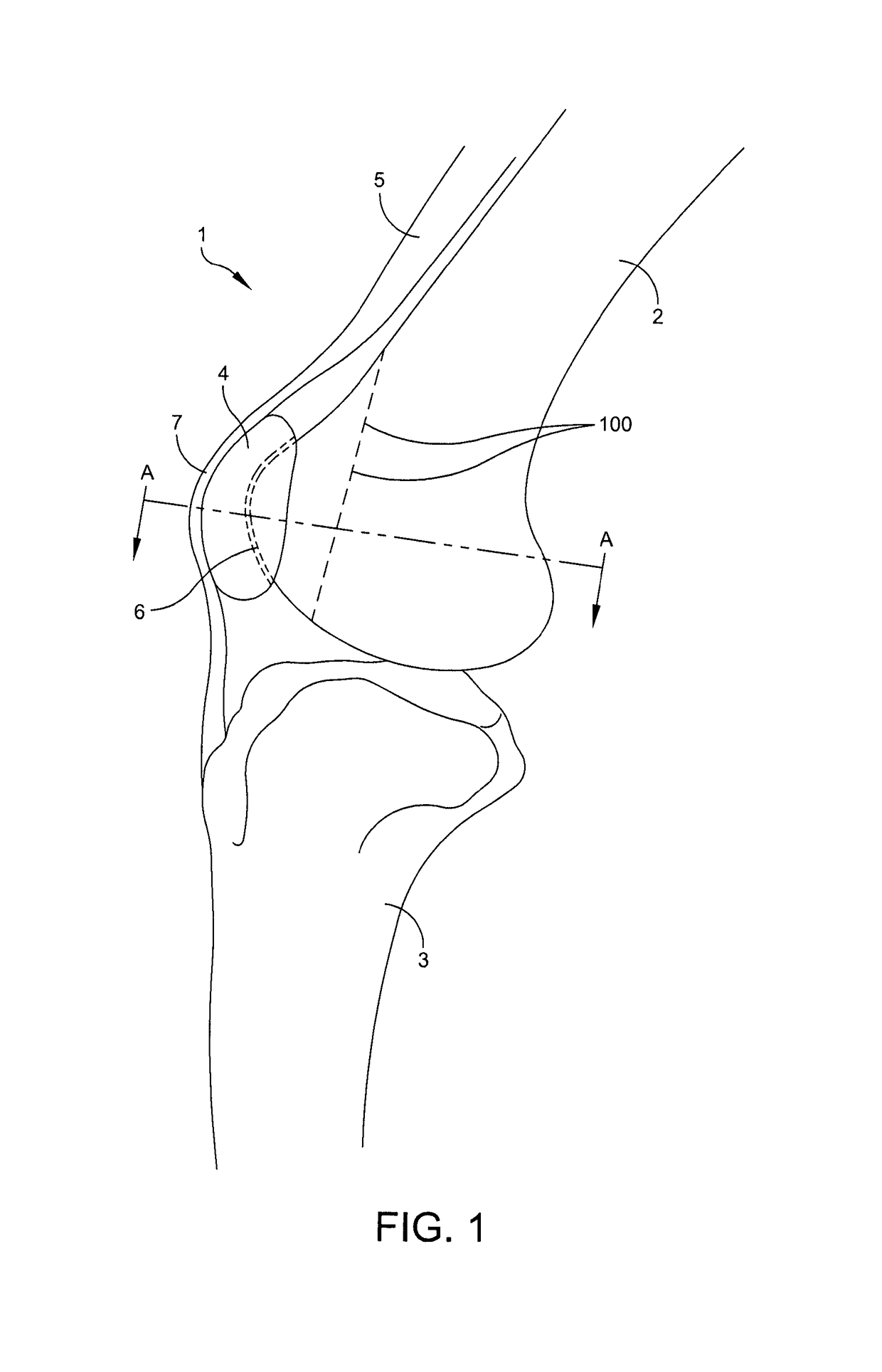 Trochlear groove prosthesis