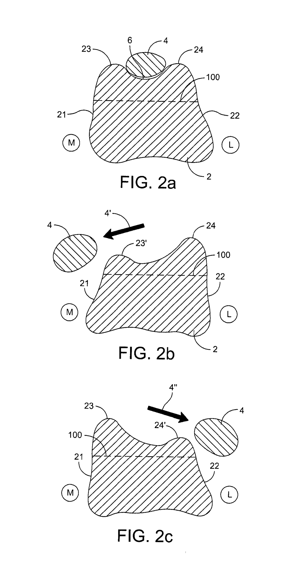 Trochlear groove prosthesis