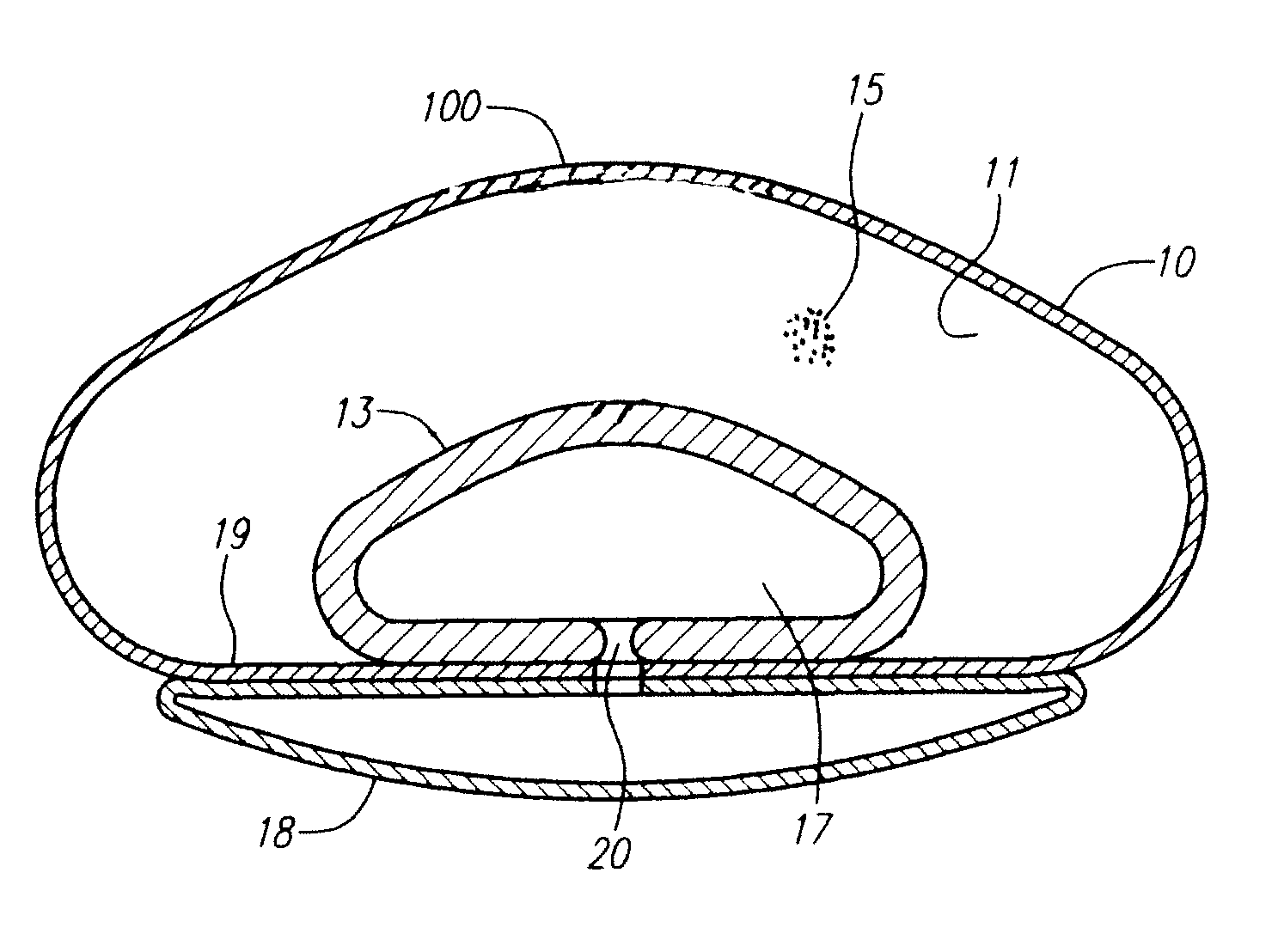 Modulating buttress saline mammary prosthesis