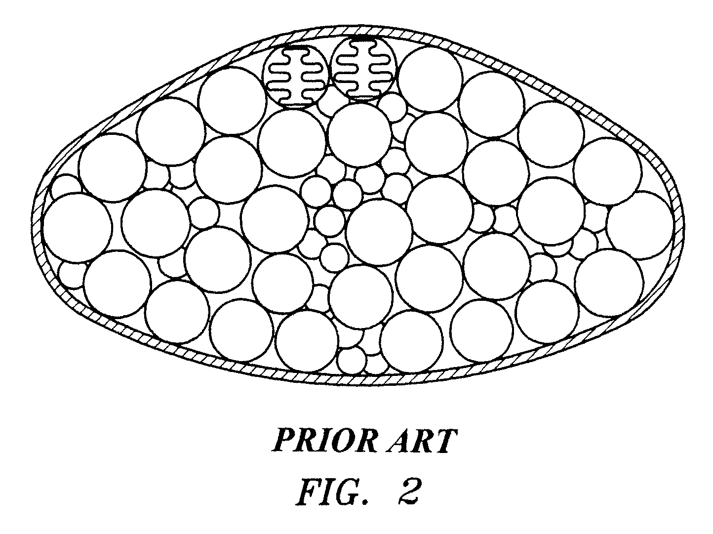 Modulating buttress saline mammary prosthesis