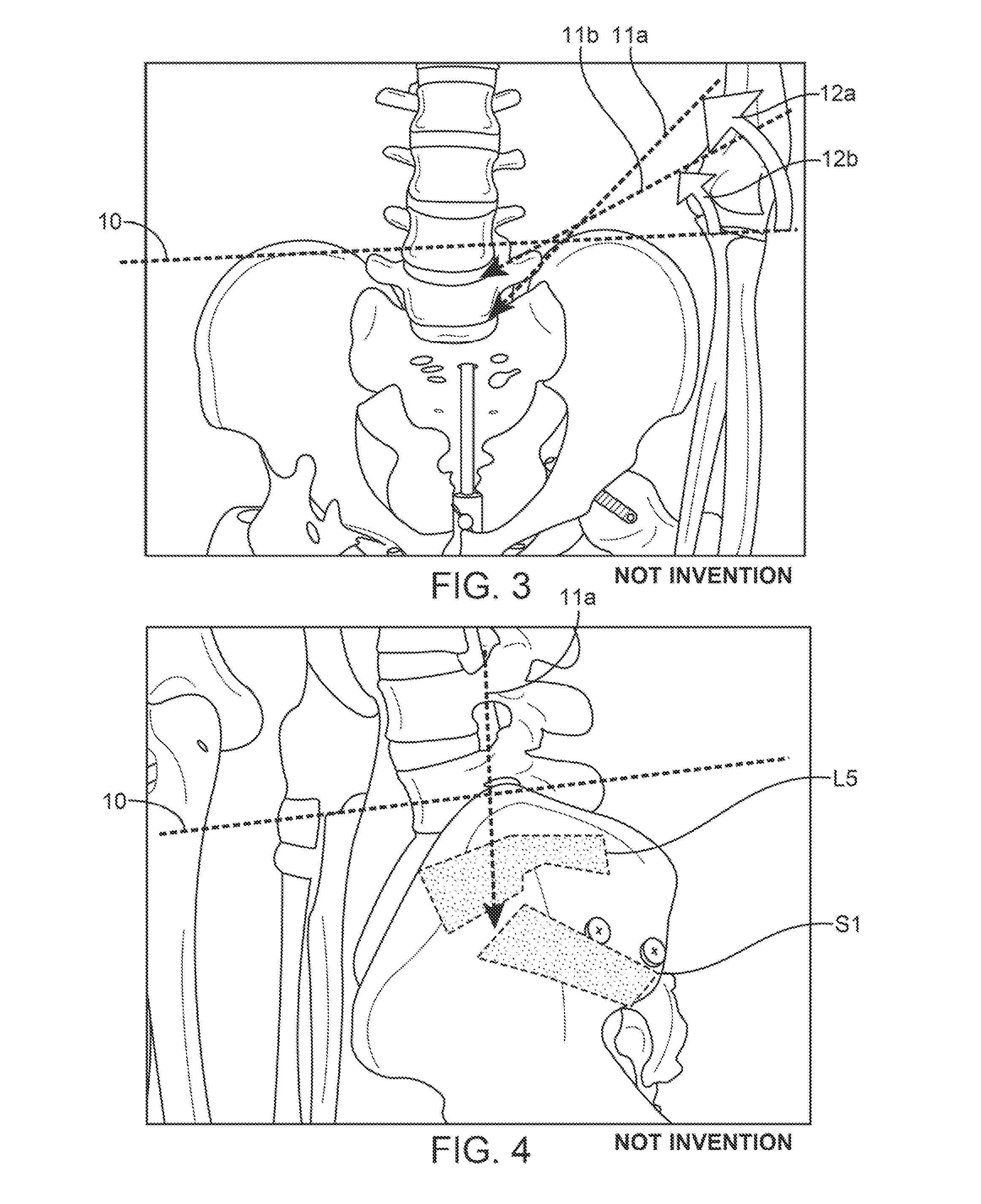 Support device and method