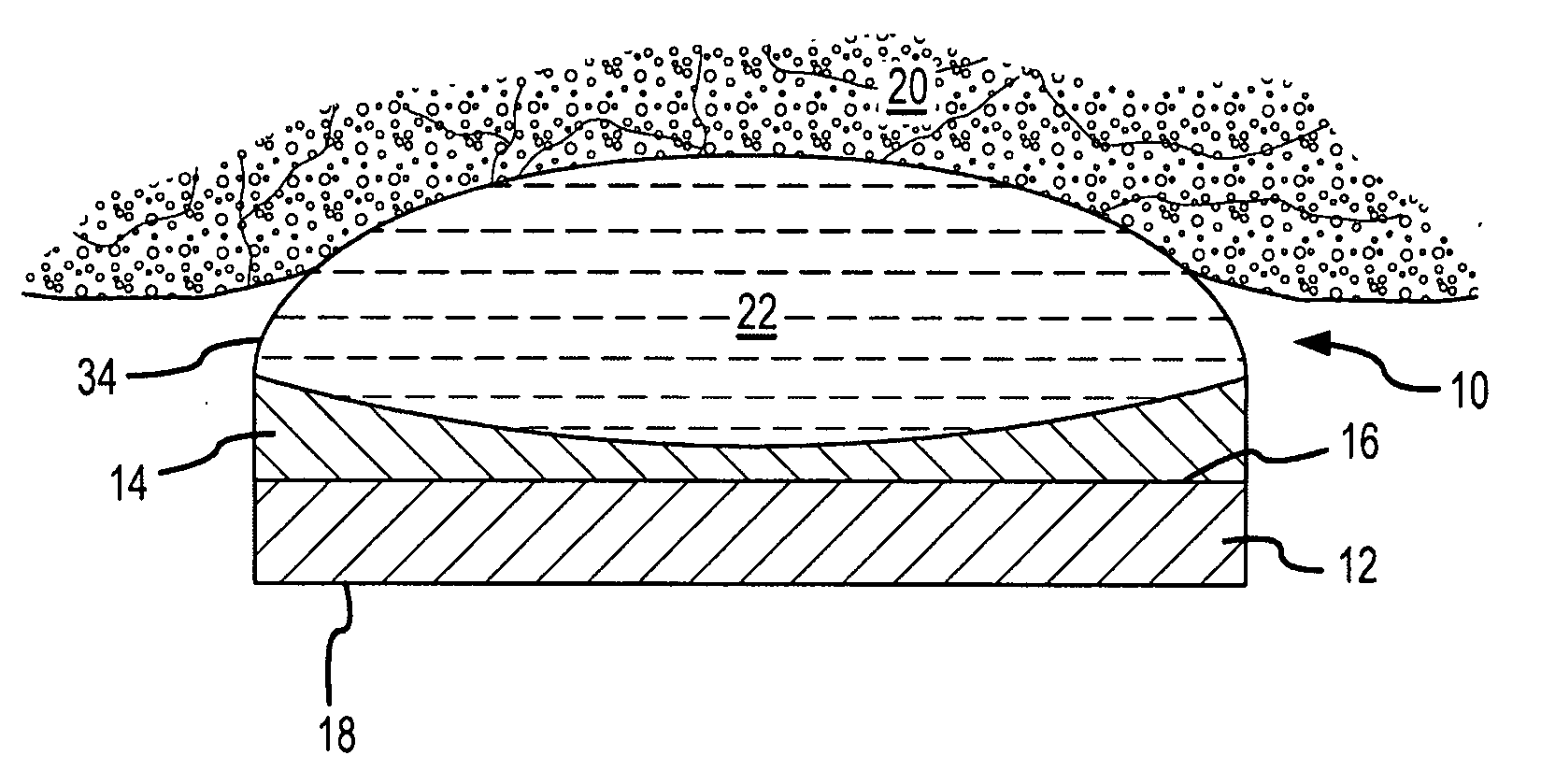 High intensity focused ultrasound transducer with acoustic lens