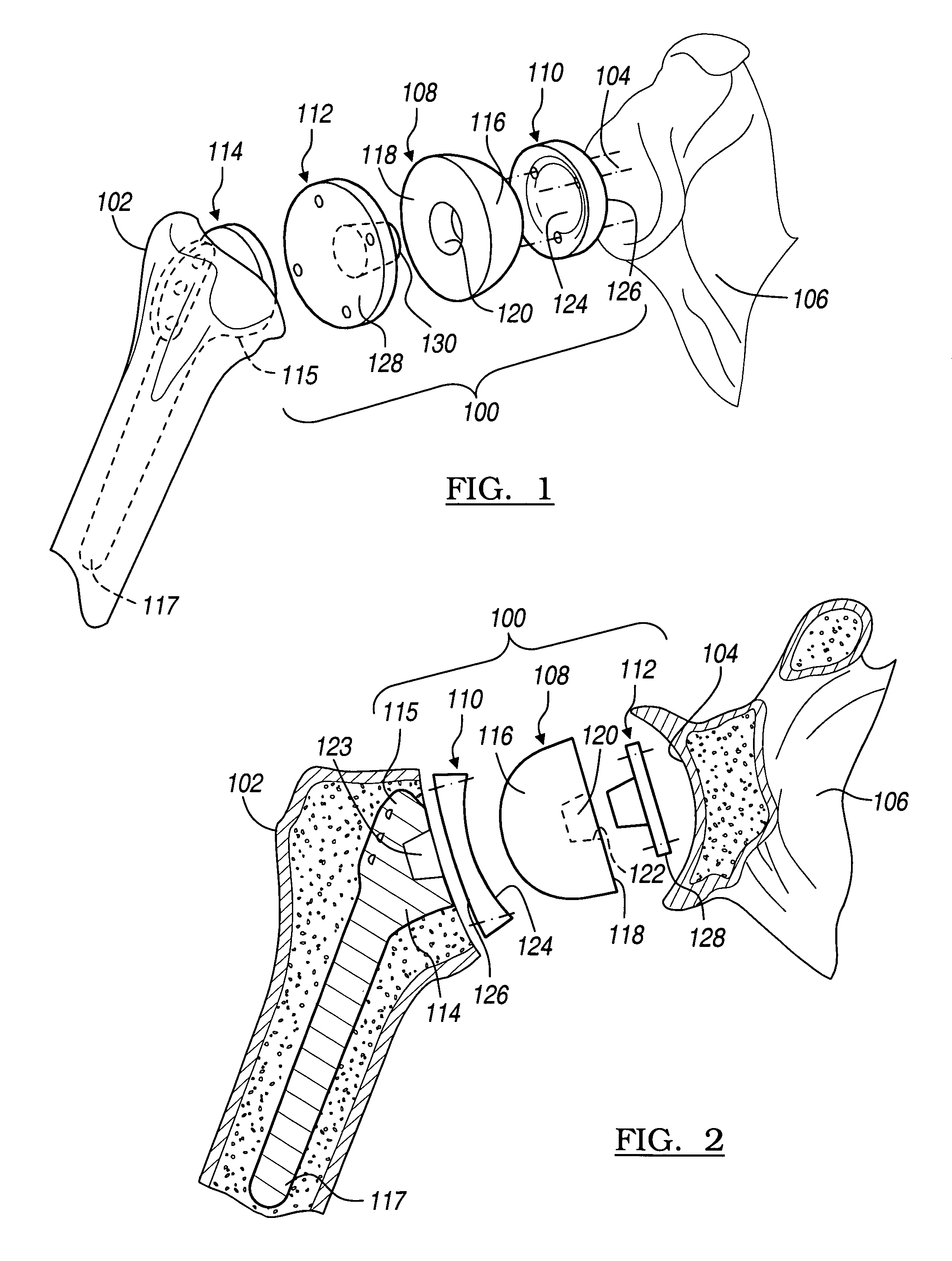 Shoulder implant assembly