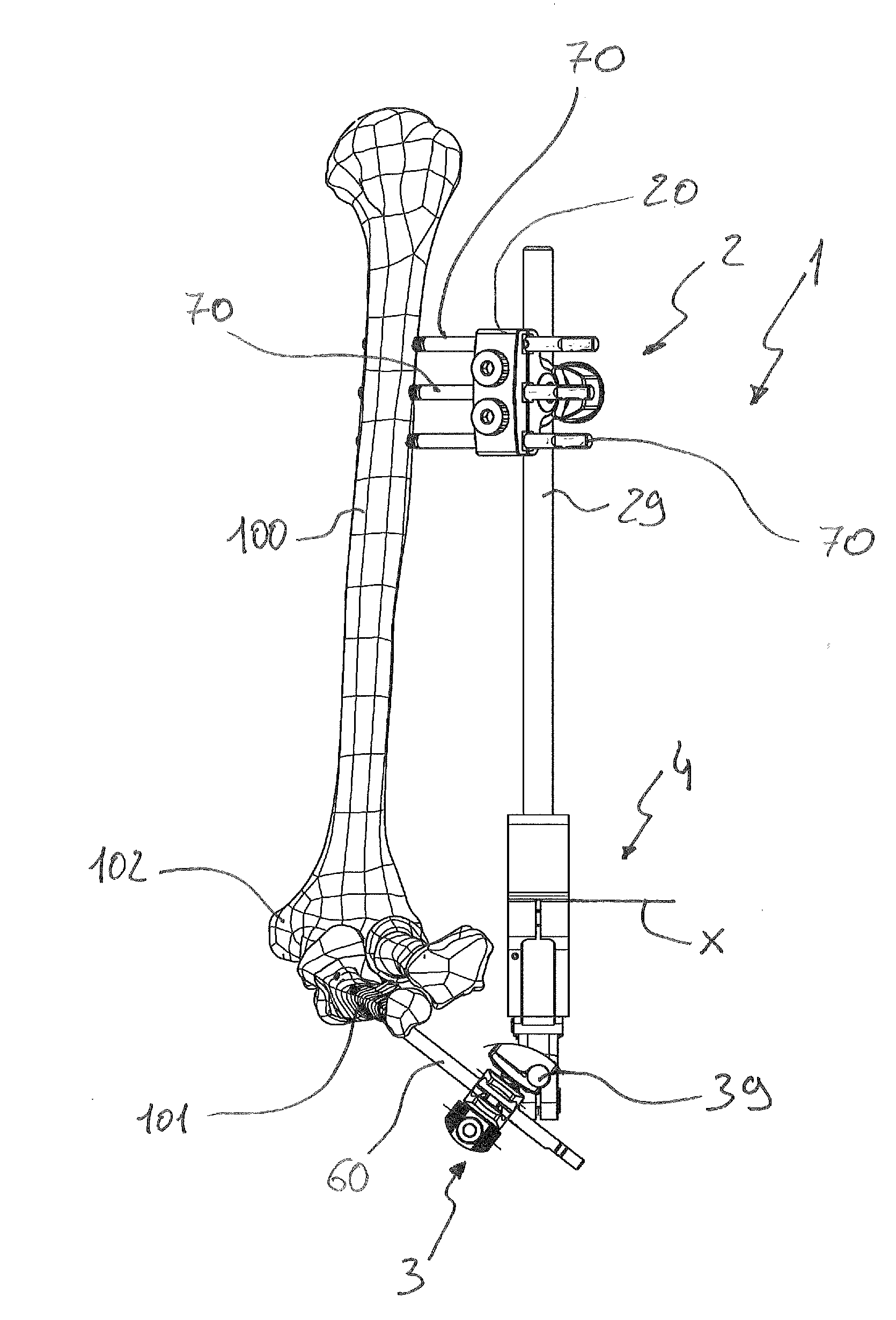 External orthopaedic fixator for the elbow joint