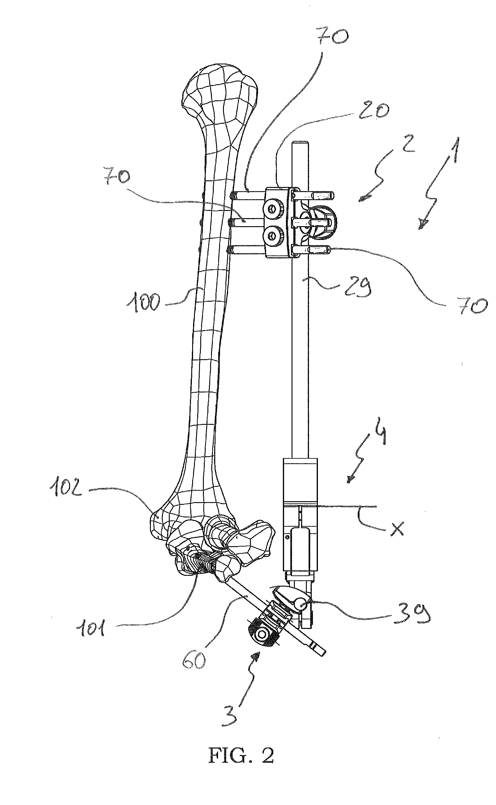 External orthopaedic fixator for the elbow joint