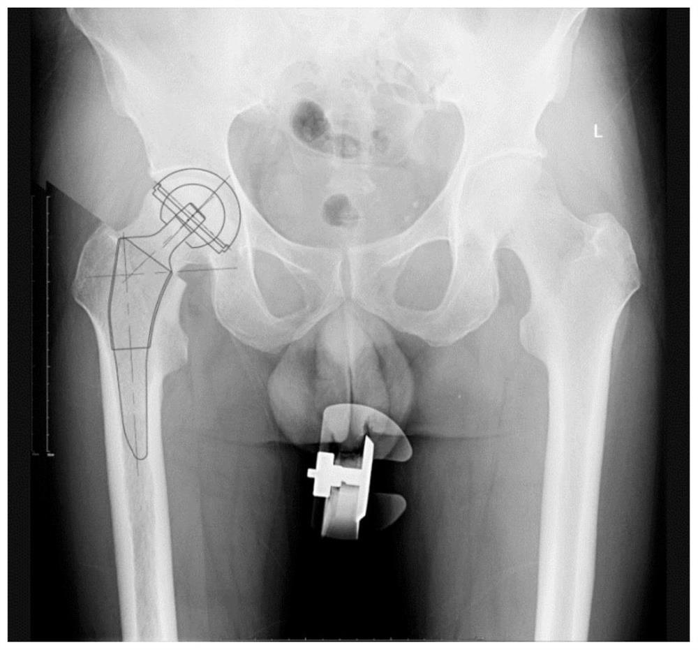 Total hip replacement preoperative planning method and device based on deep learning and X rays