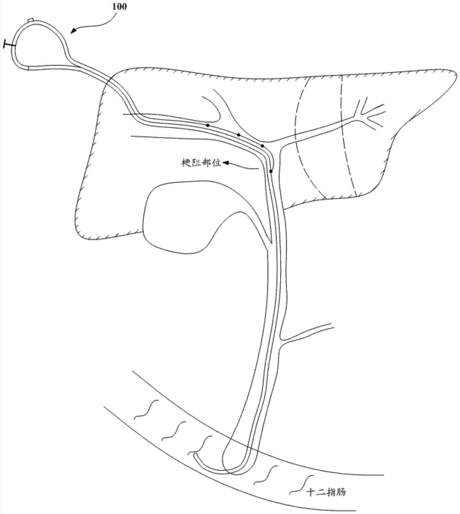 A biliary drainage device