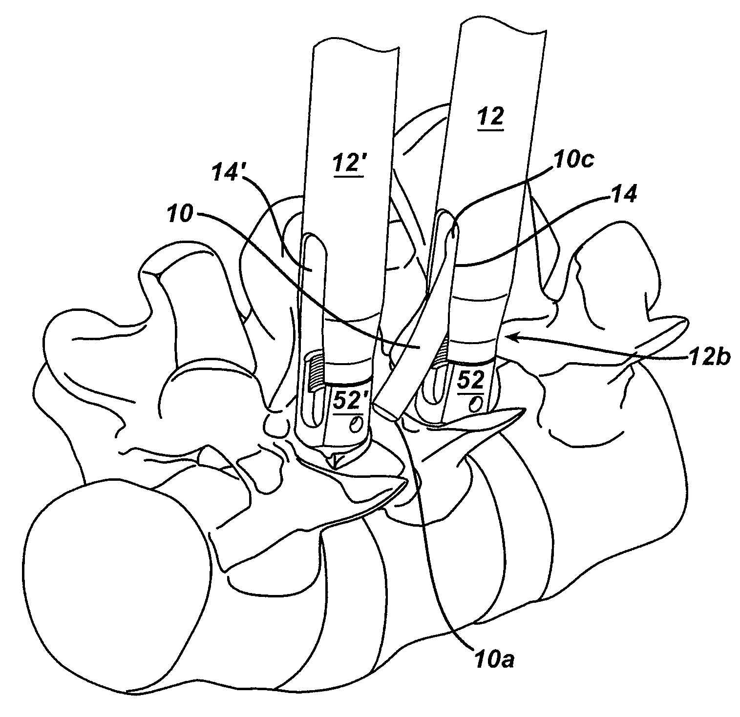 Spinal fixation element and methods