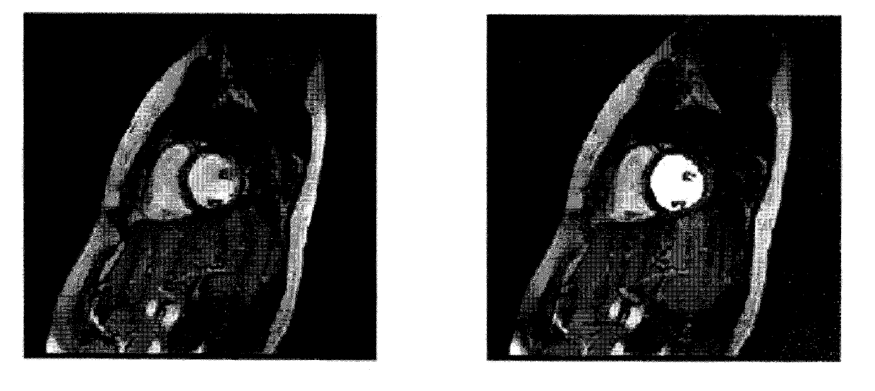 Method for fully-automatically segmenting and quantifying left ventricle of cardiac magnetic resonance image