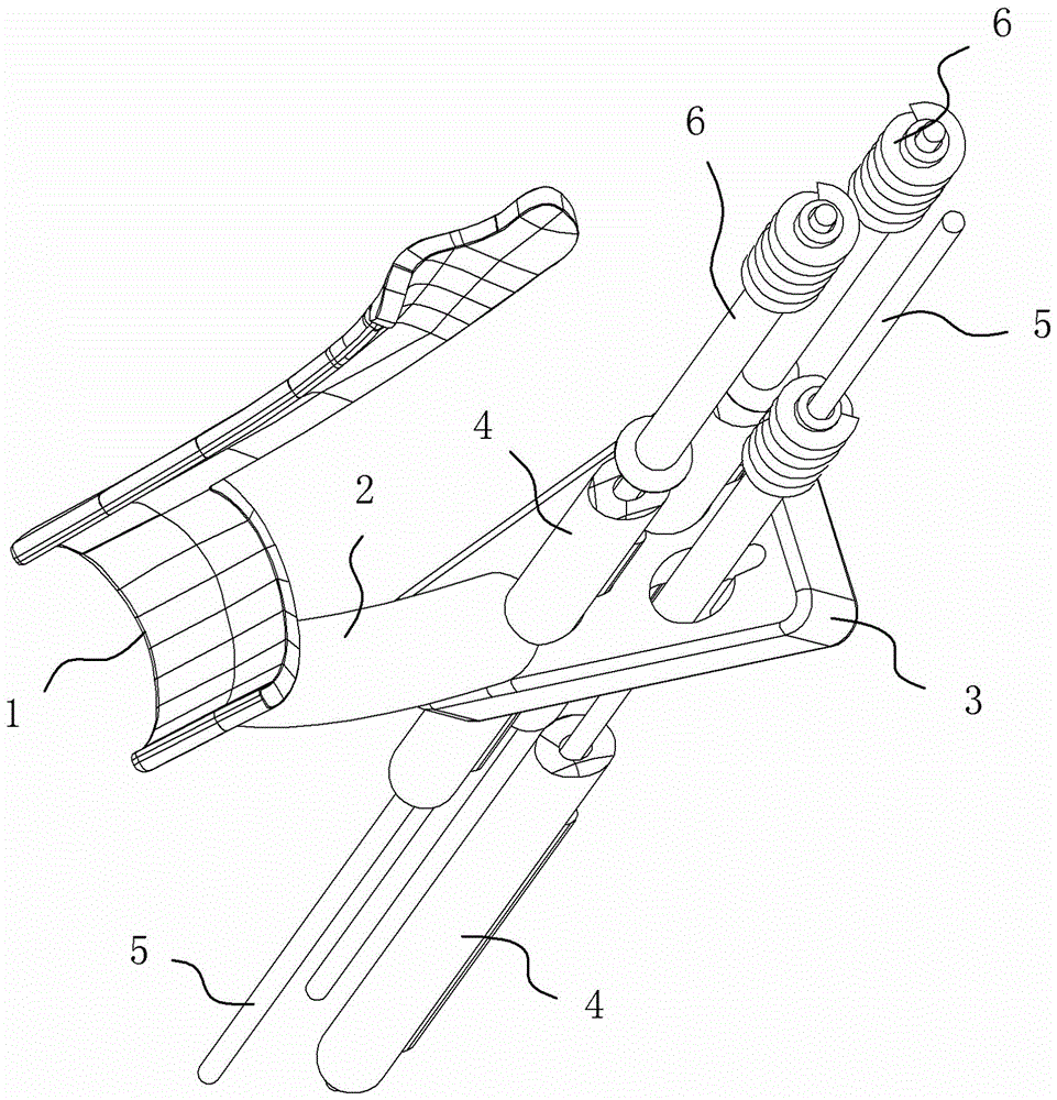 Three-dimensional reverse customization femoral neck fracture surgical navigator and using method thereof