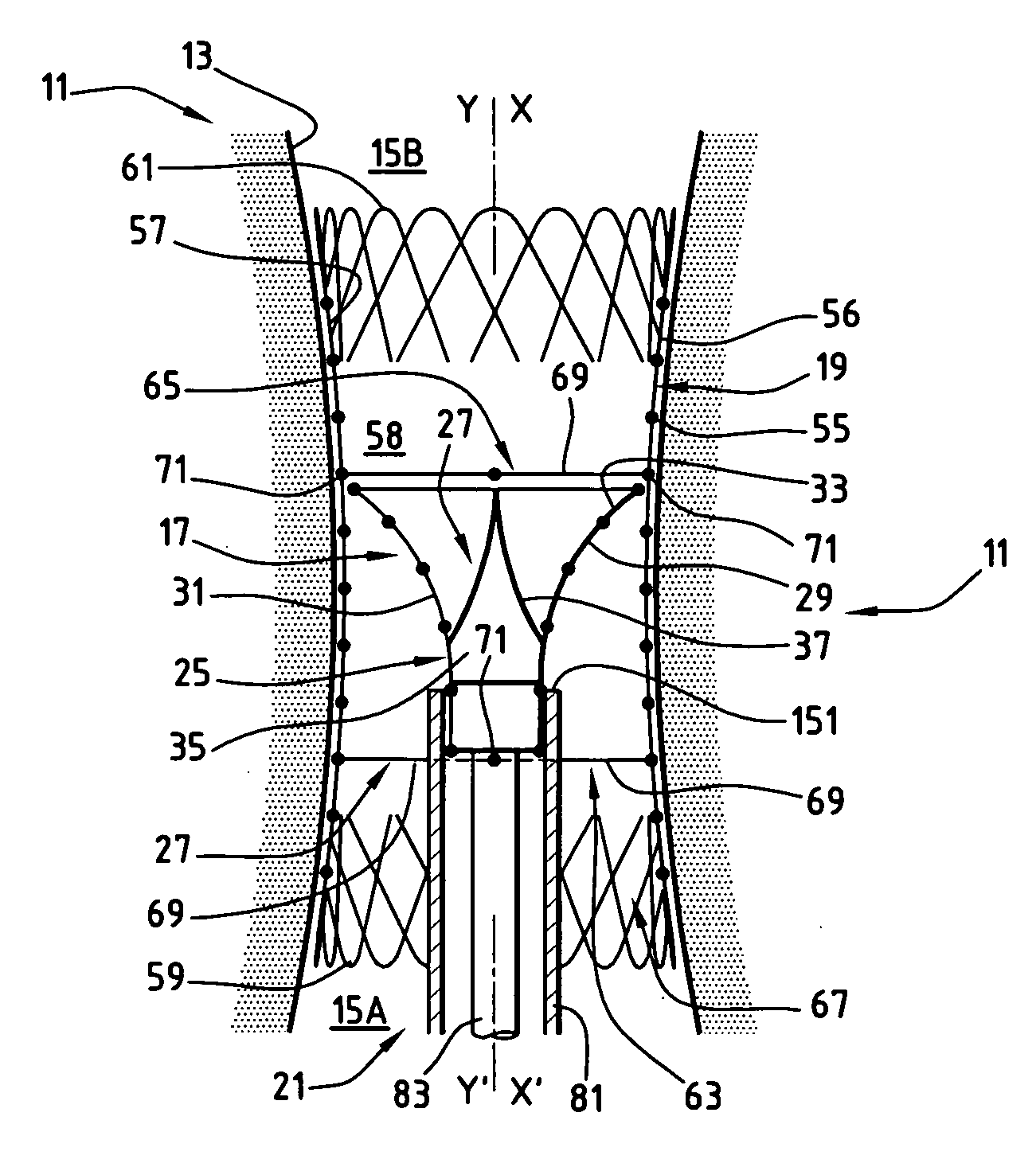 Kit to be implanted in a blood circulation conduit